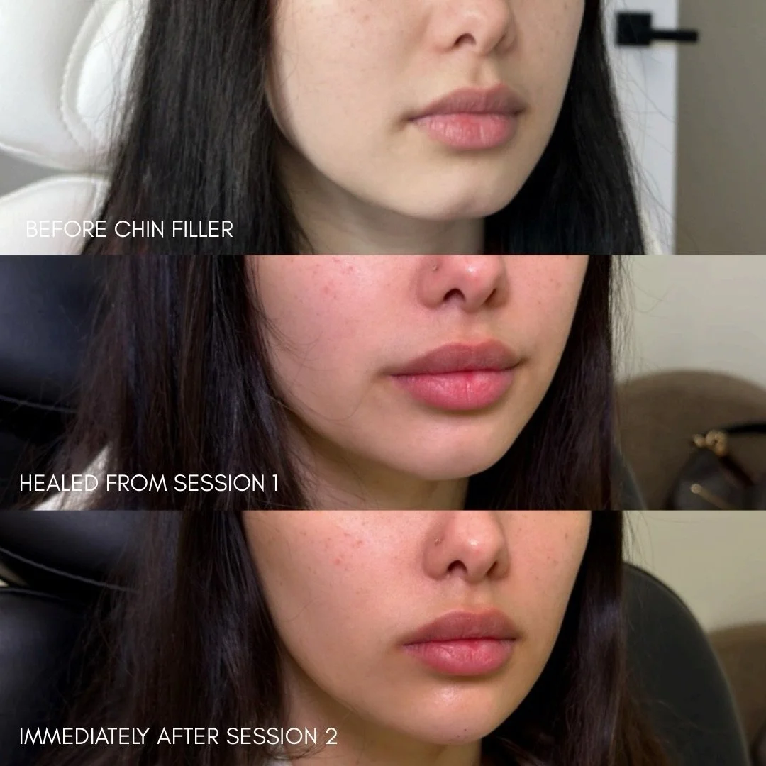Chin augmentation to address cleft chin and introduce a tapered appearance

My sweet client initially came to see me for chin filler to reduce the appearance of her cleft chin.

During this first session, we primarily focused on adding volume to the 