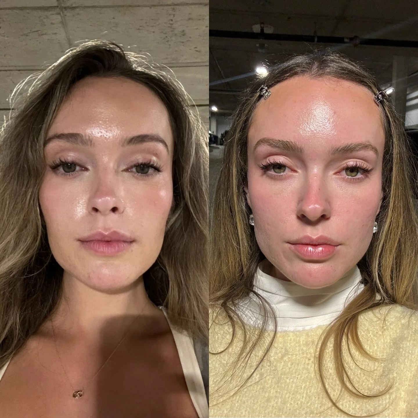 Collagen Stimulation on our @plumpedbyemma utilizing Hyperdilute Radiesse (4 months before &amp; after) 

Radiesse: more than just a filler

Radiesse is a versatile bio-stimulator that not only provides immediate volume, but also supports your body&r