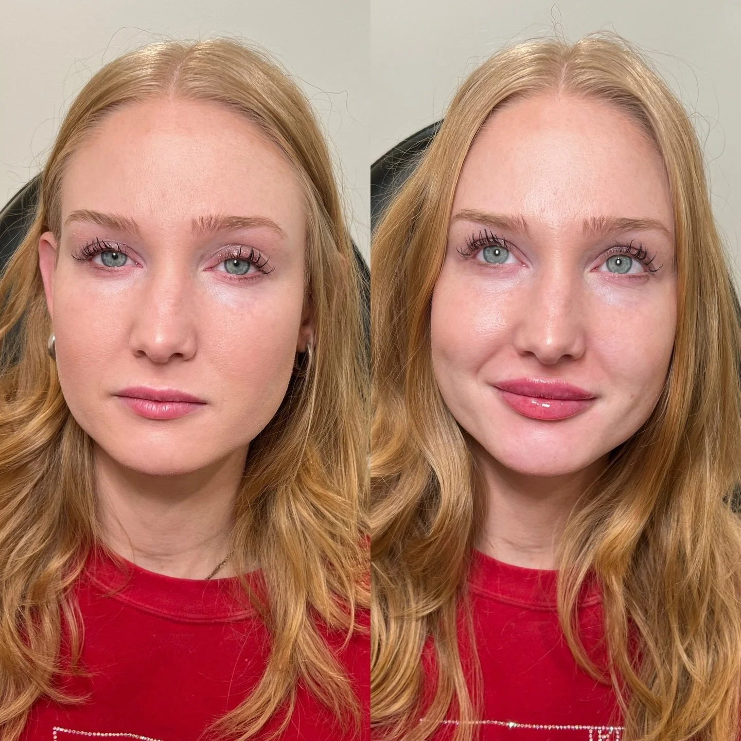 The way Lip Filler can make you glow> 

This patient asked me to preserve her natural shape, but to increase the vertical height to her lips. She preferred a more round shape, and equal volume in top and bottom lip. 

Location: Plump Medspa 
Servi