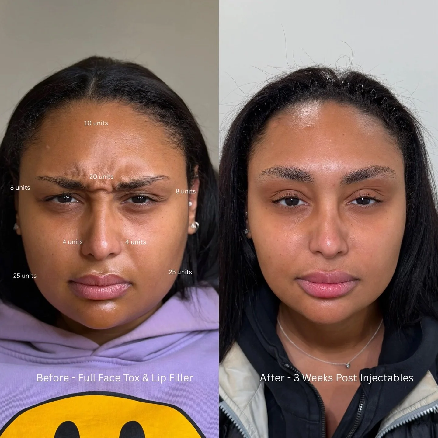 Full face tox + lip filler for balanced refinement

This treatment combined full face neuromodulator, including masseters, with lip filler to create a smoother, more balanced result. Tox was used to soften the forehead, reduce a gummy smile, and slim