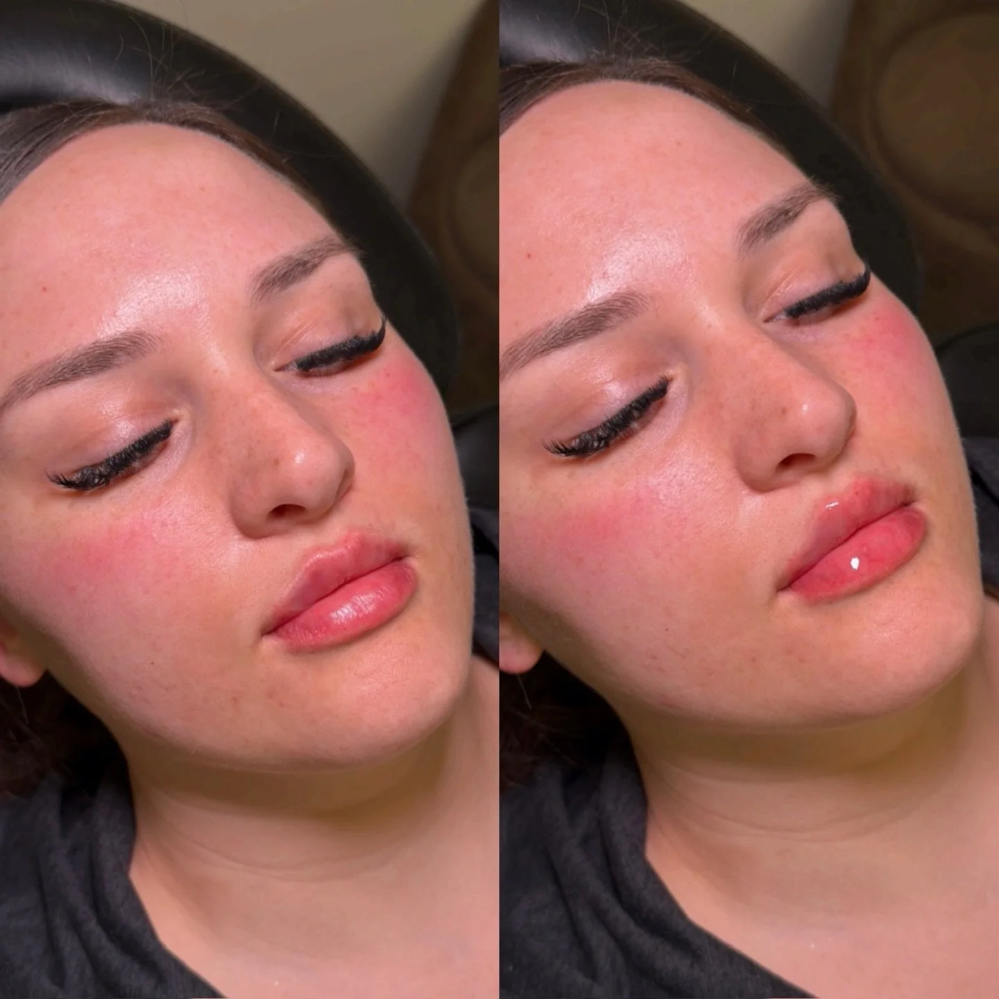 Bringing her dream lips to life using Plump&rsquo;s Russian Signature technique 

My client had a small volume of existing filler that we had placed several months ago to introduce subtle hydration for her first lip filler experience.

After letting 