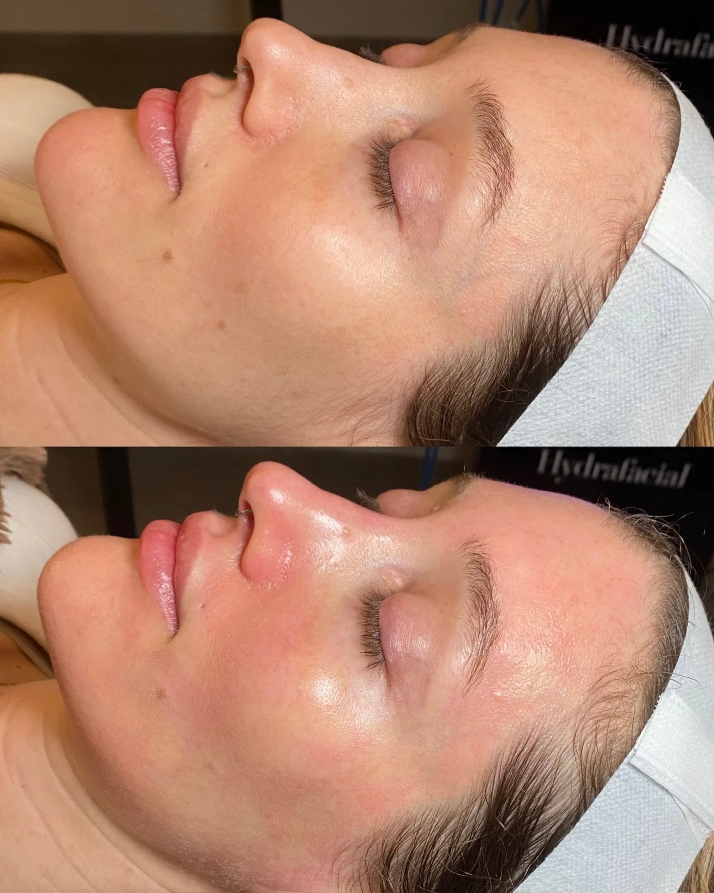 A deep clean with the Deluxe HydraFacial! 

Redness right after treatment is completely normal and typically subsides within a few hours, but the glow and hydration will stay.

Treatment: Deluxe HydraFacial
Location: Plump Medspa

#hydrafacial #glowi