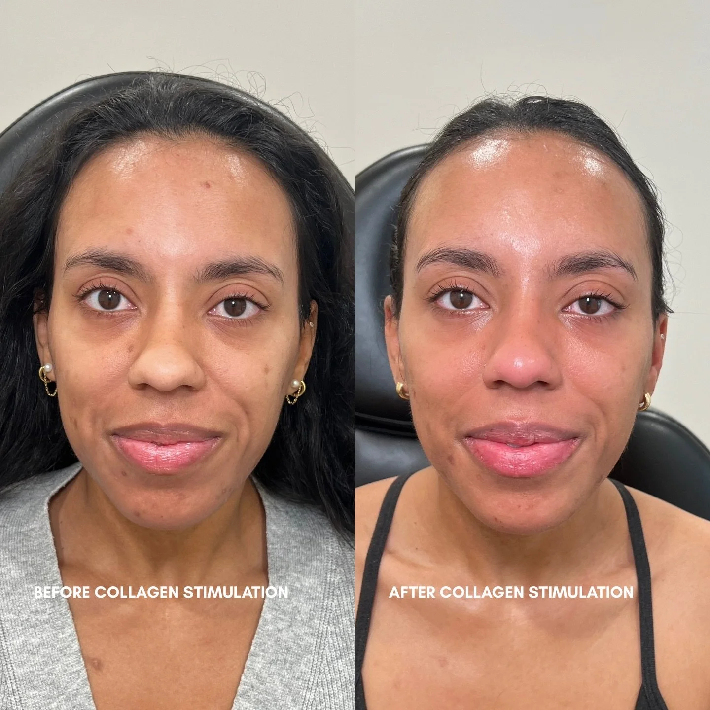 Bringing her back to life using my favorite collagen stimulator @radiesse 💉

Radiesse is the only filler that provides biostimulation while adding volume. For this wonderful patient we focused on a global treatment for her entire face. We did this t