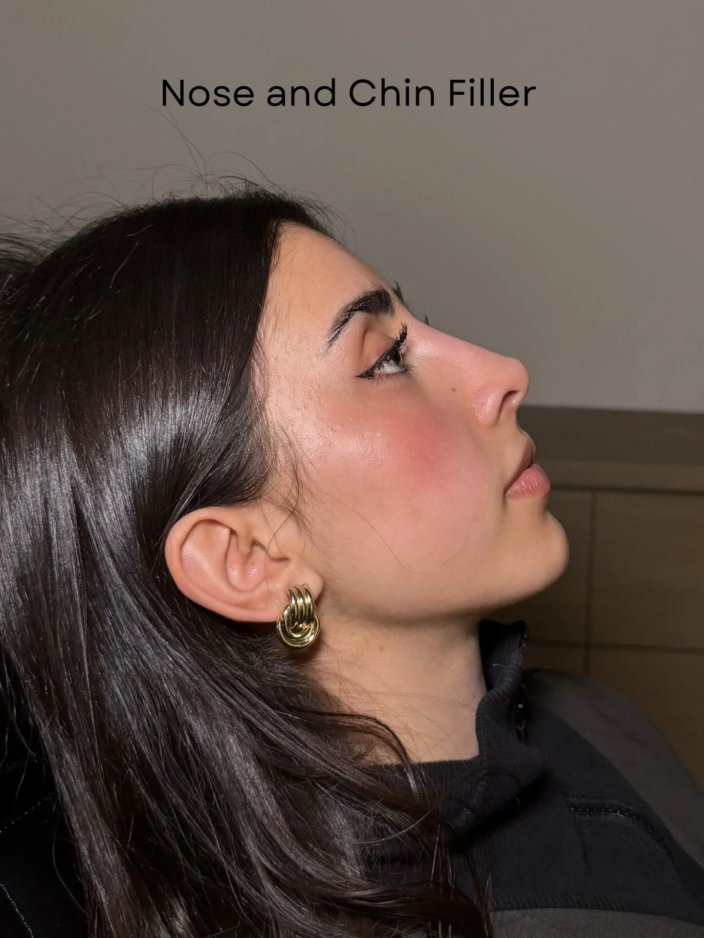 Chin + nose filler for profile balance

This before and after shows a healed liquid rhinoplasty result. At this visit, we refined her profile further by adding filler to the chin to create additional balance and support through the lower face. Enhanc