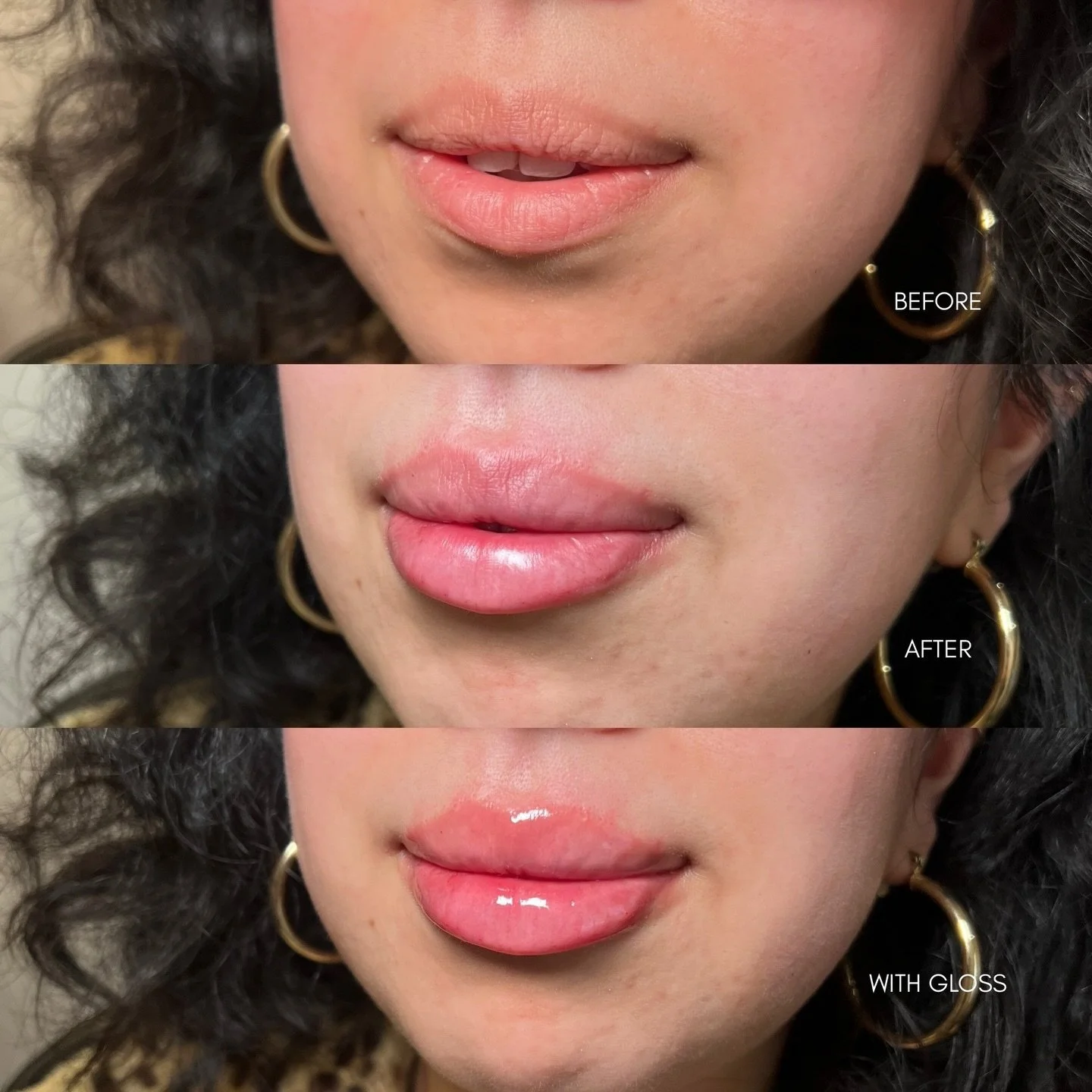 Classic Lip Technique using @revanesseusa 

This patient wanted to maintain her natural structure of her lips and keep them well defined. We focused on hydrating any areas of texture, while adding subtle volume for the perfect pout. 

Location: Plump
