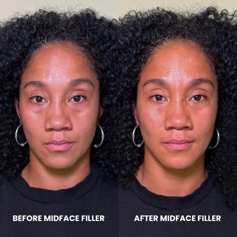 Volume restoration in the midface to refresh and rejuvenate 

When clients come in with concerns about their nasolabial folds, the solution isn&rsquo;t always found in the fold itself. True rejuvenation starts with the foundation: the midface.

As we