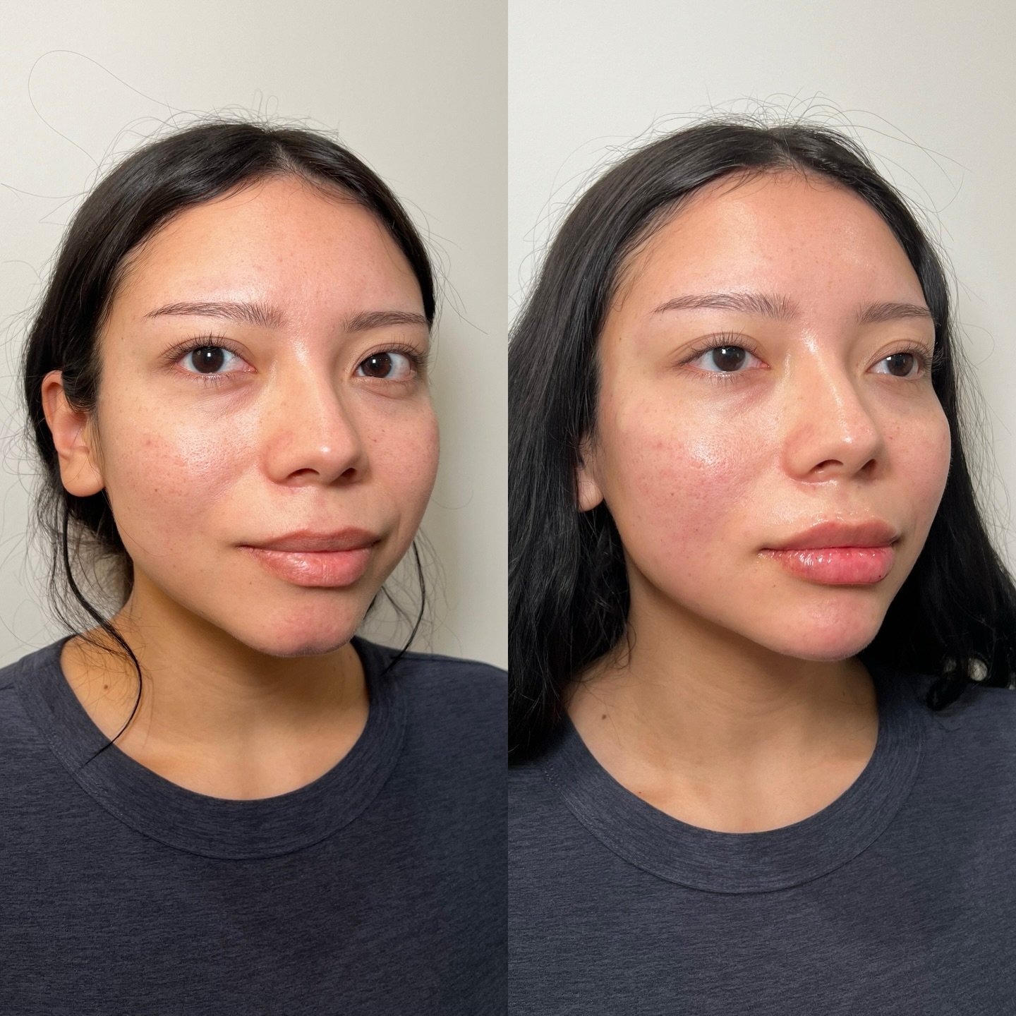 Facial Balancing to harmonize the face. 

Our patients main concern was her nasolabial folds (NLF), and jawline. 

When addressing the NLF, we always address the posterior portion of the face before directly injecting into this are. Placing unnecessa