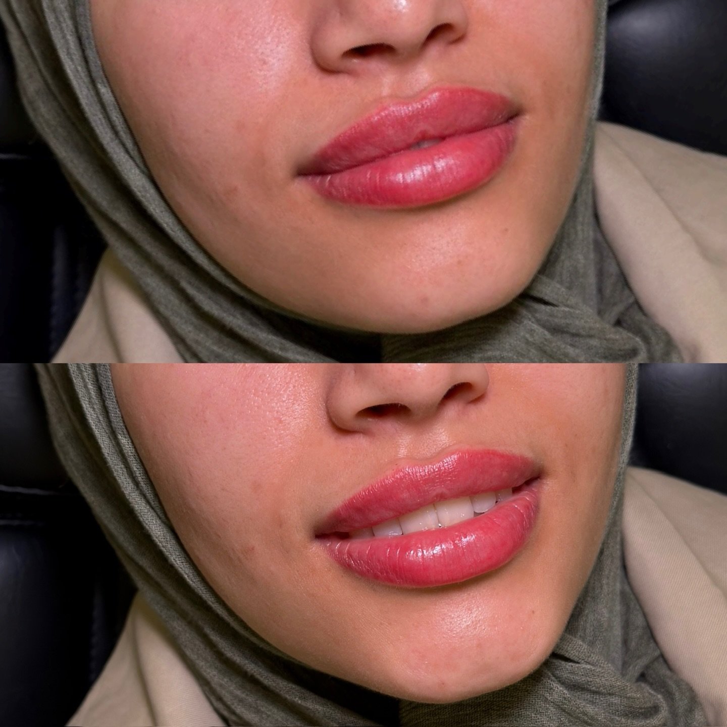 Subtle. Defined. Undetectable. 🪞

When a patient requests a natural outcome, it is imperative to be intentional with our technique.

For this patient, we utilized a Classic approach to provide structural support to the central lip architecture.

Our