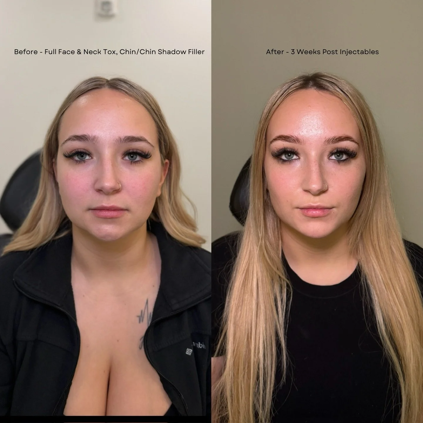 Full face tox + chin refinement

This treatment combined upper face tox to smooth the forehead and create a subtle brow lift, masseter tox for facial slimming, and neck tox to enhance jawline definition. To complete the look, we added chin and chin s
