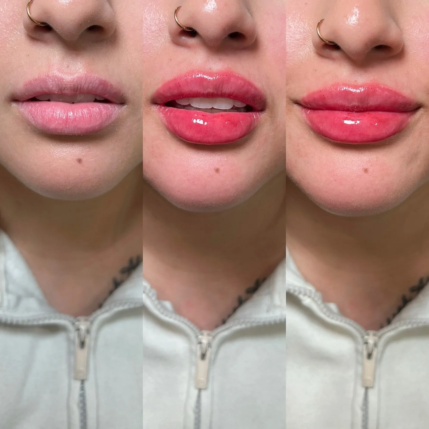 &ldquo;I&rsquo;m so picky with my face, and you killed it&rdquo; were her first words when she saw her new lips. 

The consultation is the one of the most important parts of your appointment. Together we discuss the reason why you want to get a servi