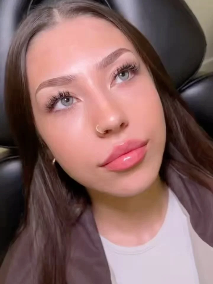 I had the honor of treating our beautiful Patient Coordinator, Merari.

After a few rounds of dissolving focused on her top lip, we were left with a clean canvas on which I could restore both shape and volume.

Her requests included:
&bull; A sharp, 