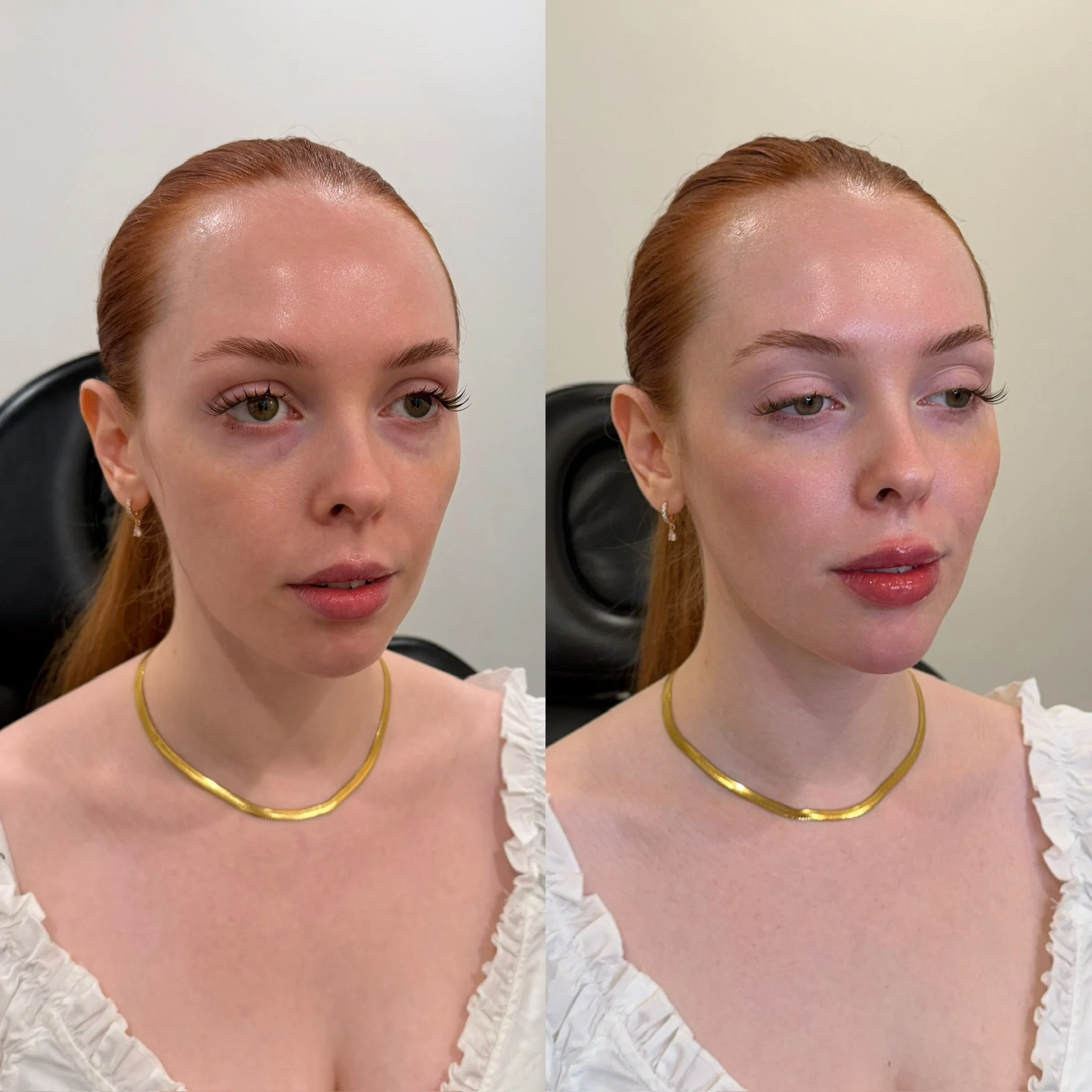 Full facial balancing with filler 

This returning client came in for continued refinement after one previous session of filler and tox. This visit focused on facial balancing through the cheeks, chin, jawline, and lips to enhance structure, improve 