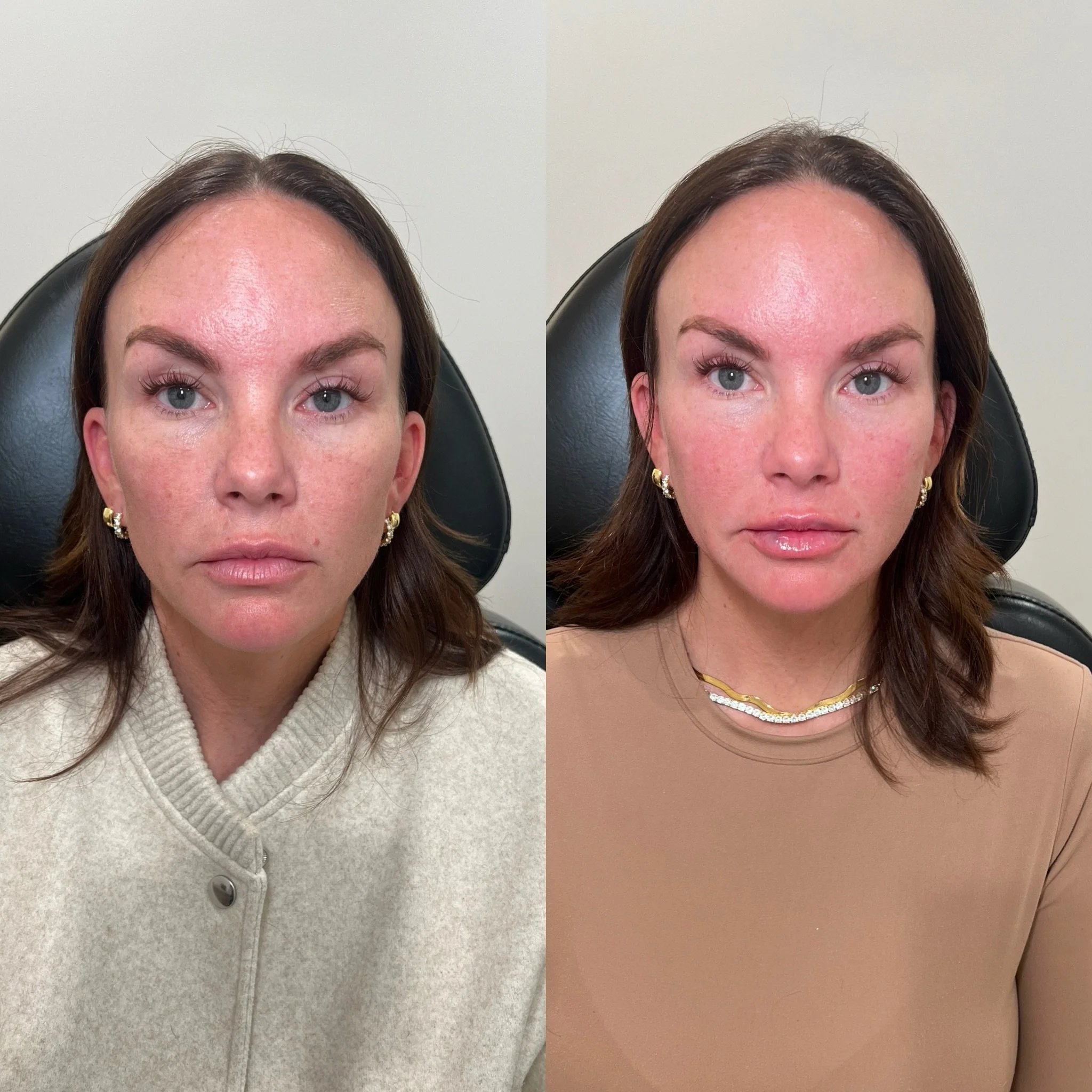Airbrushed Facial Balancing using a collagen stimulator @radiesse 

This gorgeous patient of mine came to me for Jawline Filler in hopes to correct her side profile and improve jowling. 

After failed attempts in the past with filler, and completely 