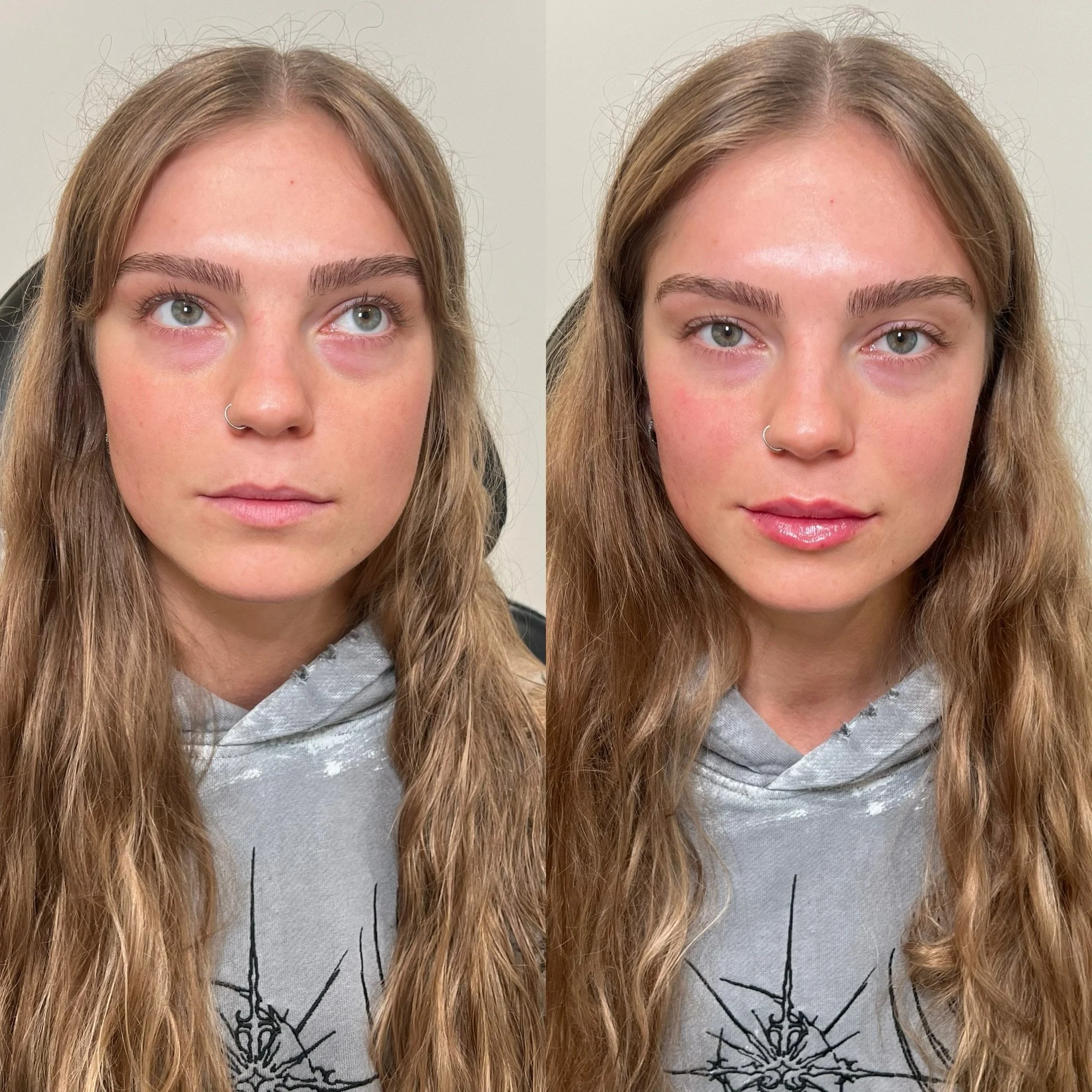 Lip filler attracts the attention of the eye when looking at the face. 

A balanced, proportionate lip can compliment one&rsquo;s features rather than distract. 

Tasteful, long lasting, crisp lips. 

#lipfiller #lipfillerbeforeandafter #lipfillerpdx