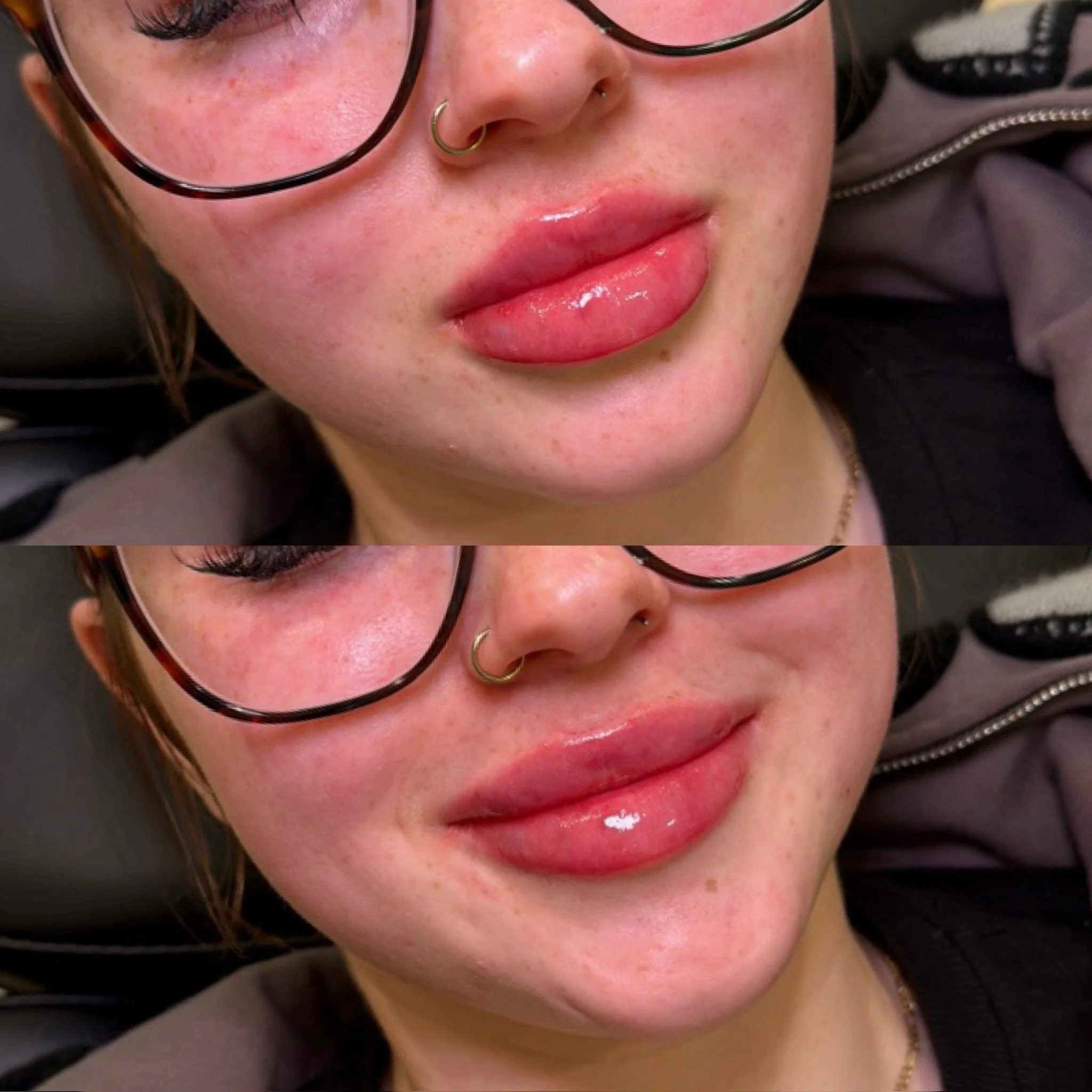 Reviving her ideal lips with structure and plump.

After dissolving her top lip and migration, we were able to reintroduce shape, volume, and overall plump to her beautiful lips.

Patience is key, and lips cannot be rushed or allow for skipping steps