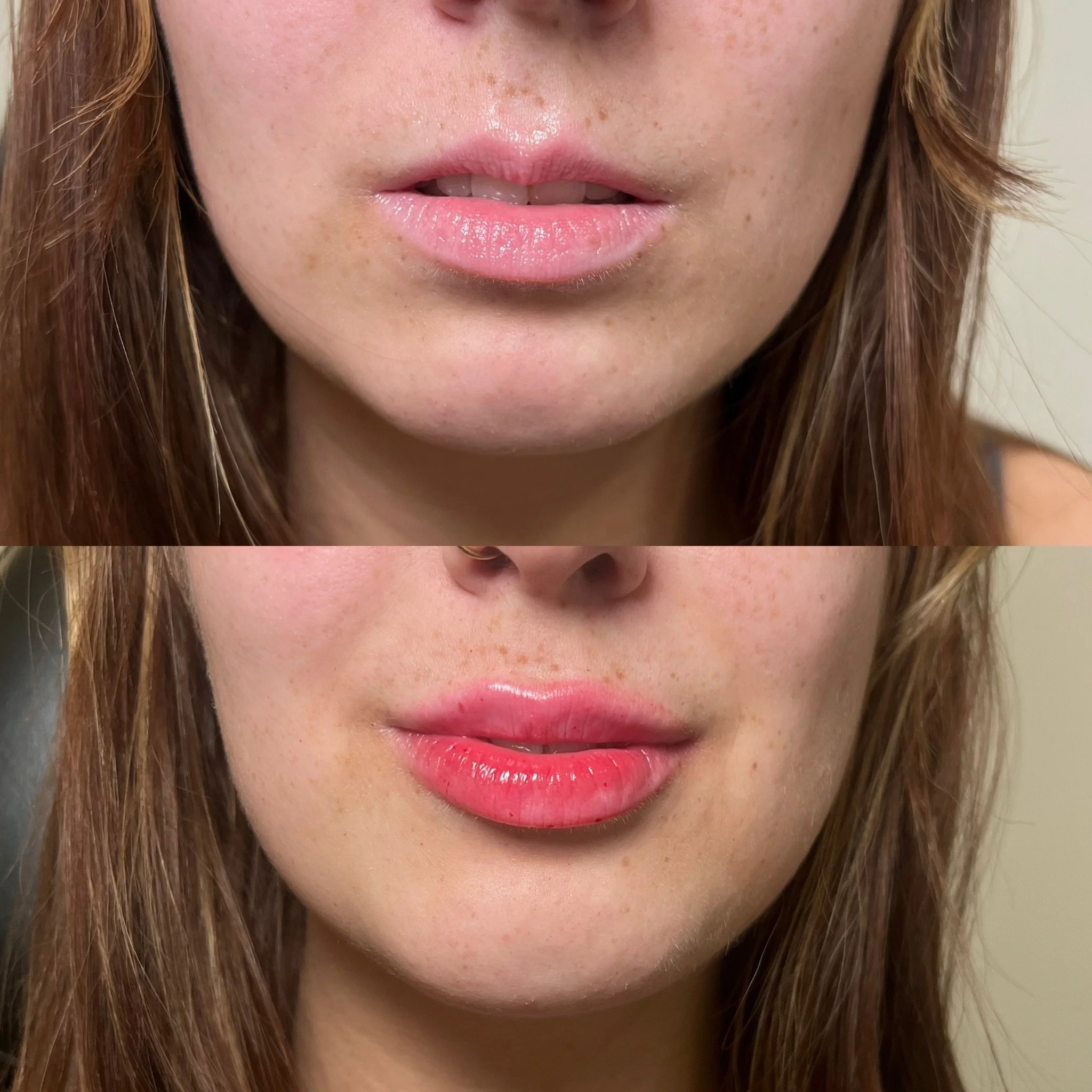 Right product, right technique, right provider. 

All 3 of these factors matter when it comes to providing the best possible outcome for a process that is so delicate. The lips are arguably one of the most challenging aesthetic devices to perform due