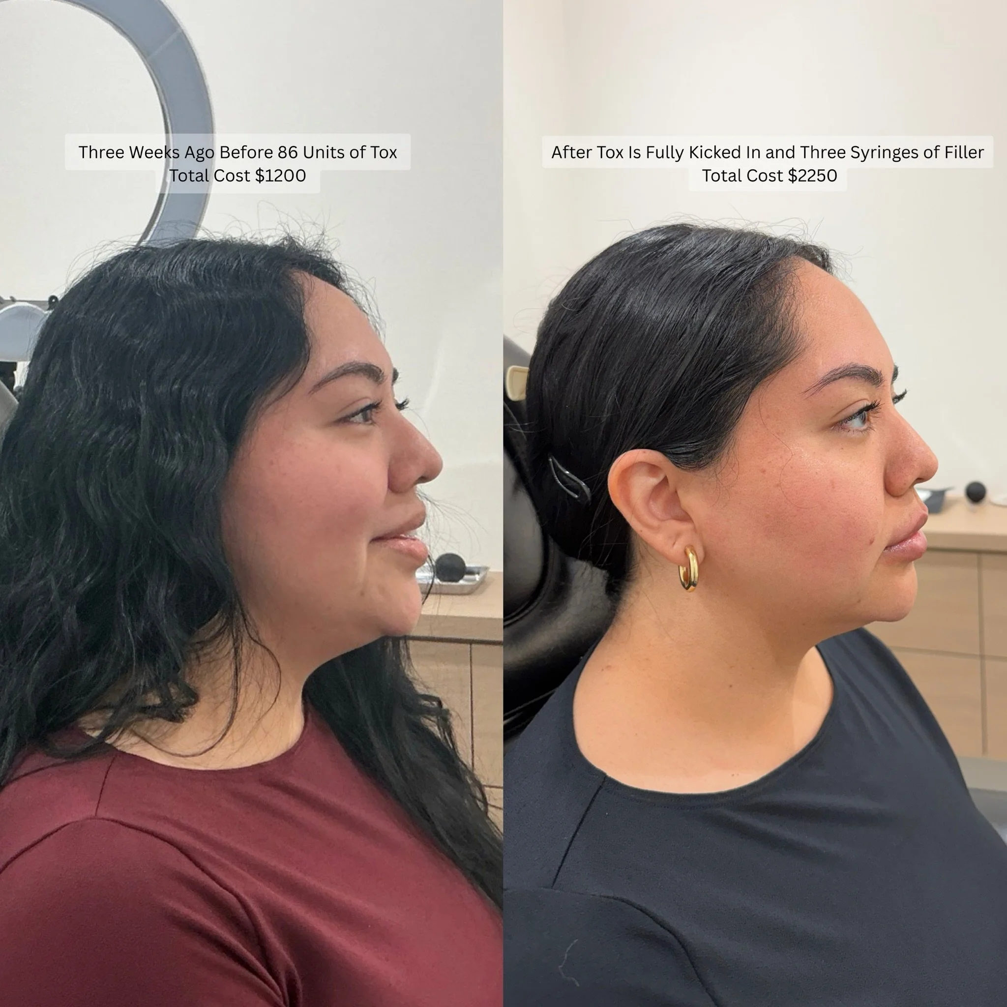 Phased treatment for refined results

This patient followed a structured approach to facial balancing. We started with 86 units of tox to address movement and create a smooth, balanced foundation. After three weeks, once results had fully developed, 