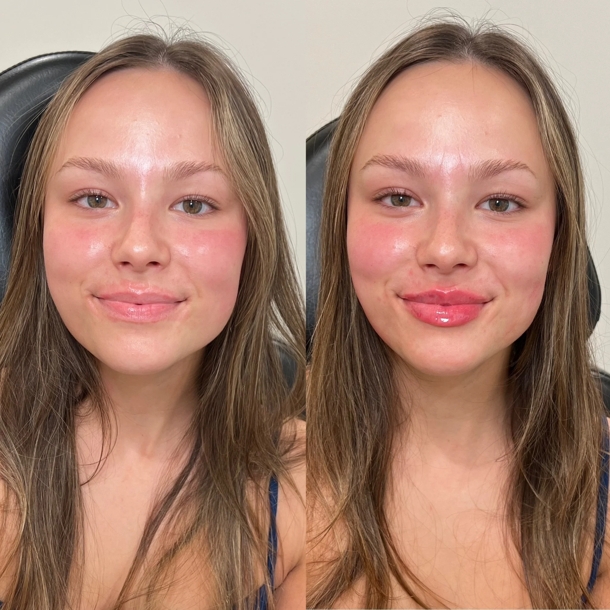 Lip Filler can change the entire face, yet stay true to you. 

Featuring our Classic Lip Filler by @plumpedbyemma 

Location: Plump Medspa 
Service: Lip Filler 

&bull; Immediate swelling ~30%, settles over ~2 weeks
&bull; Photos shared with consent
