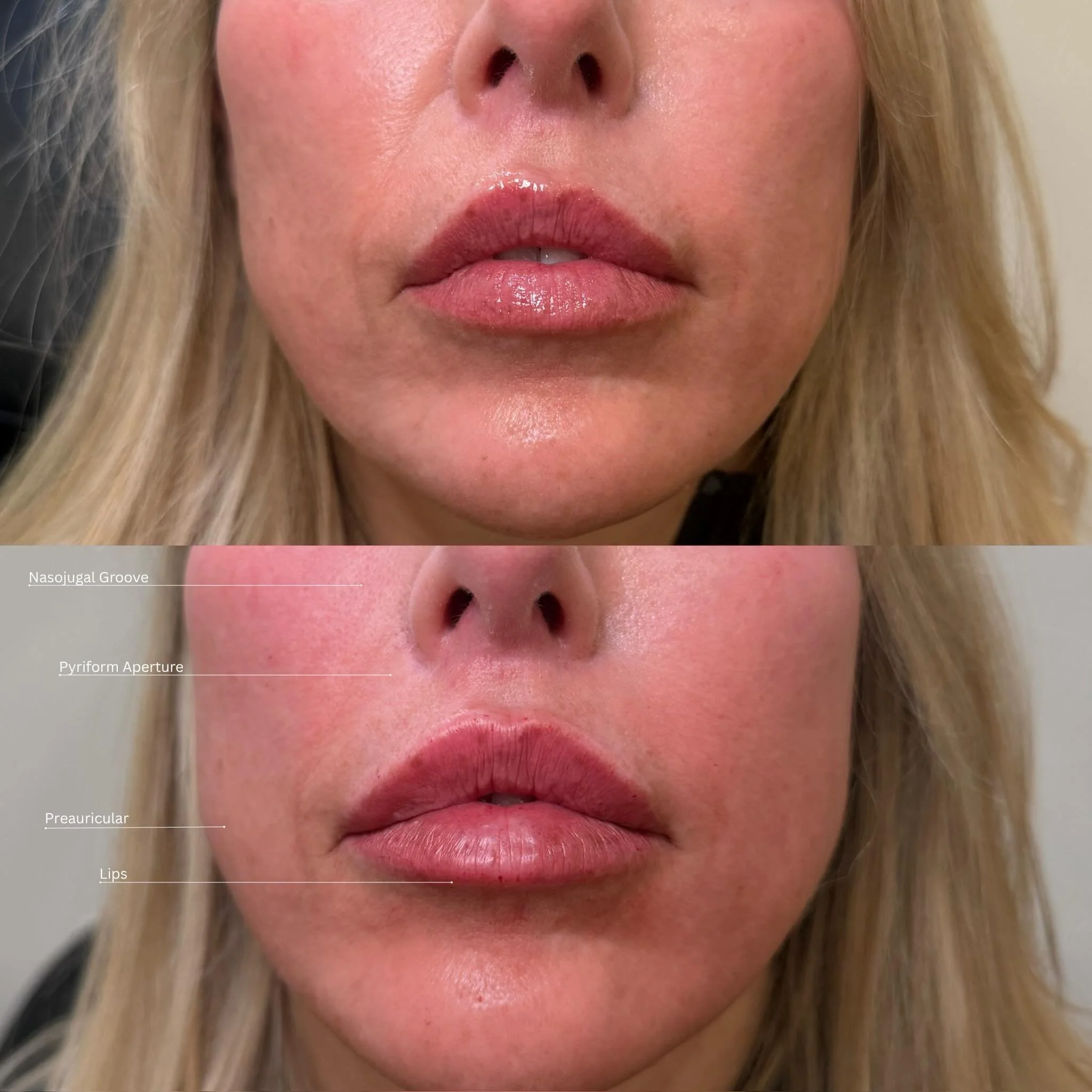 Full facial balancing with strategic filler placement

This patient came in post dissolving of previously poorly placed filler received elsewhere, with goals focused on height, shape, enhanced symmetry, and overall balance while keeping projection an