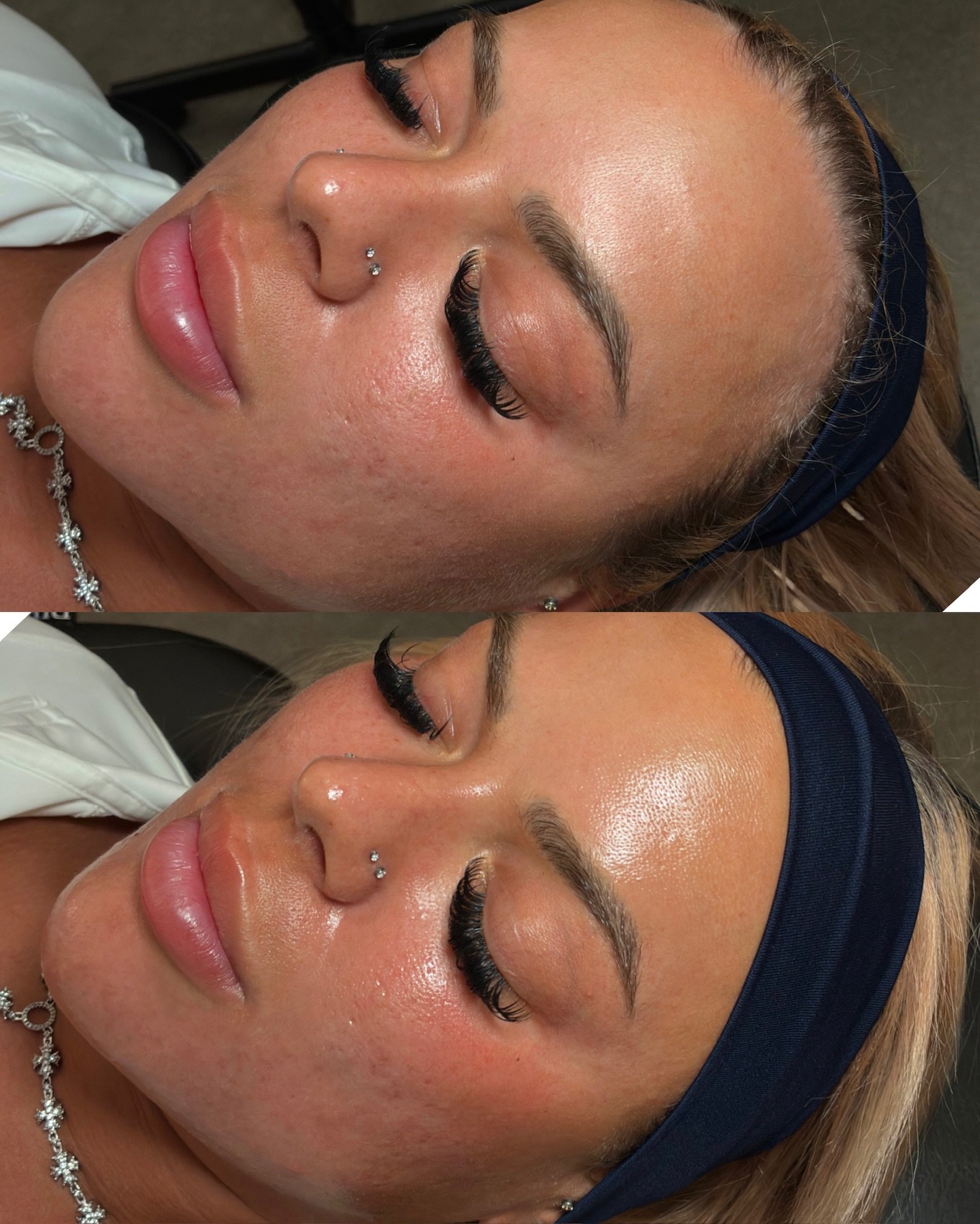 The Plump Signature Peel

Shedding the top layers of dead skin will instantly reveal a more even glowy base! Gentle chemical peels are mild yet effective, while keeping your skin barrier in tact and healthy. We can customize this peel to your skin&rs