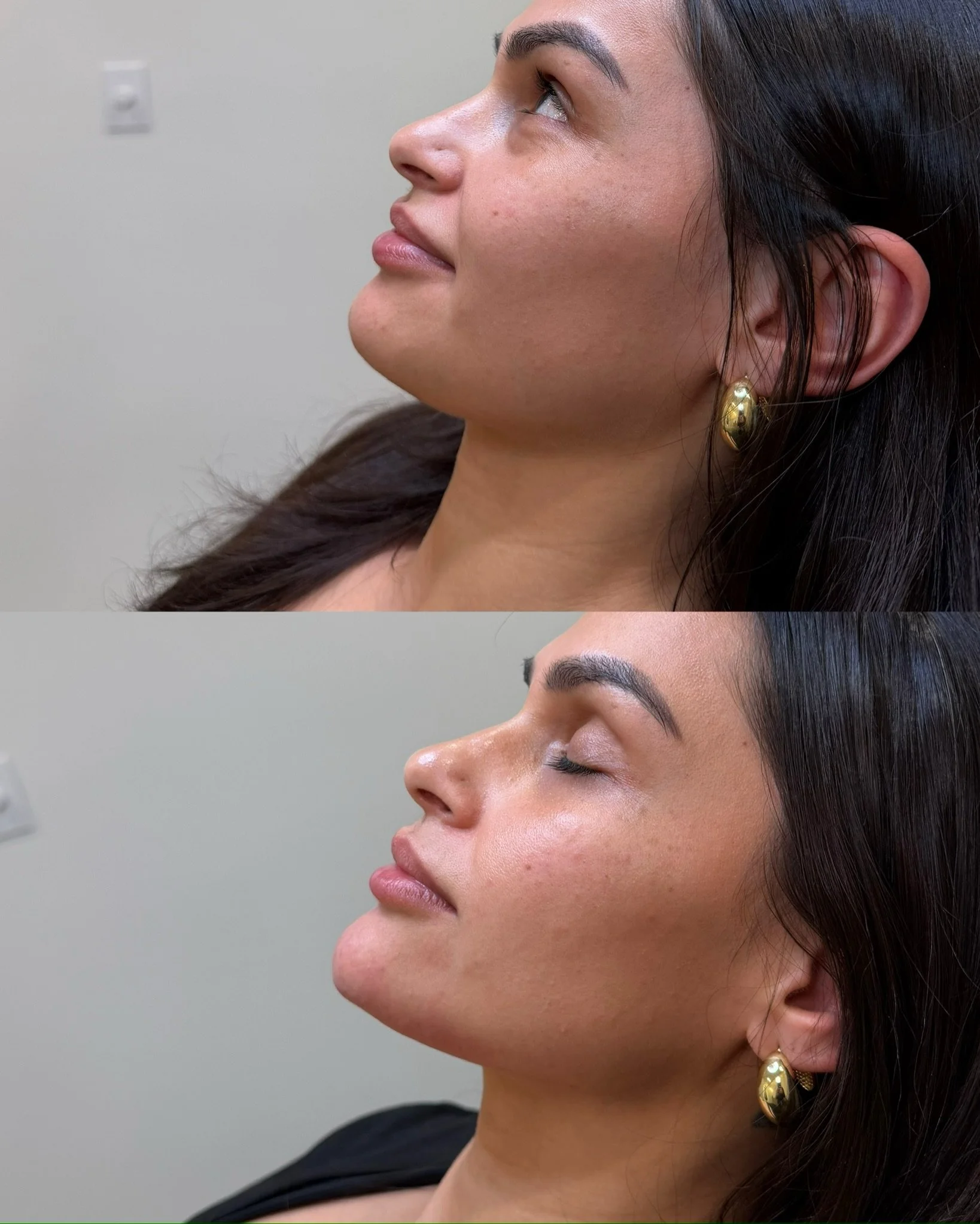Chin filler for length and projection

This treatment focused on enhancing the chin to improve length and projection, creating a more defined and balanced lower face. By strategically adding structure to the chin and blending into the pre-jowl area, 