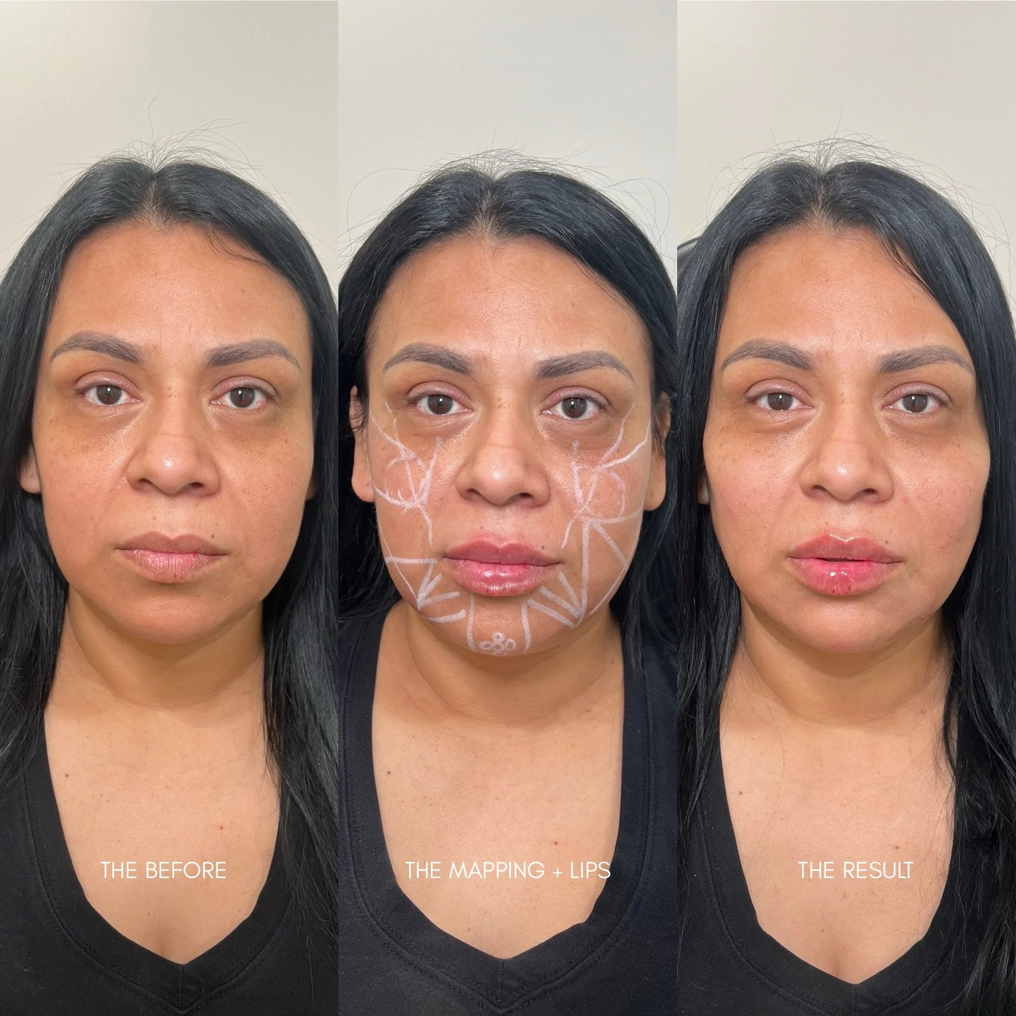 Facial Balancing using the only bio-filler on the market @radiesse 

Radiesse is a &ldquo;two-birds one stone&rdquo; type of product that restores volume and stimulates collagen simultaneously. When patients come in with the concern of volume loss an