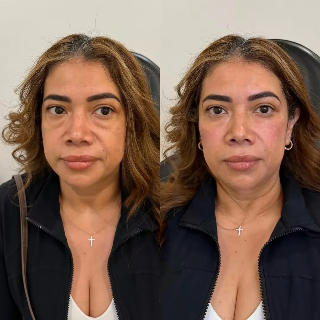 Under-eye + cheek filler for smooth, supported results

This patient came in concerned with puffy under-eyes. We used tear trough filler in combination with cheek filler to add support and improve the transition between the lower eyelid and midface. 