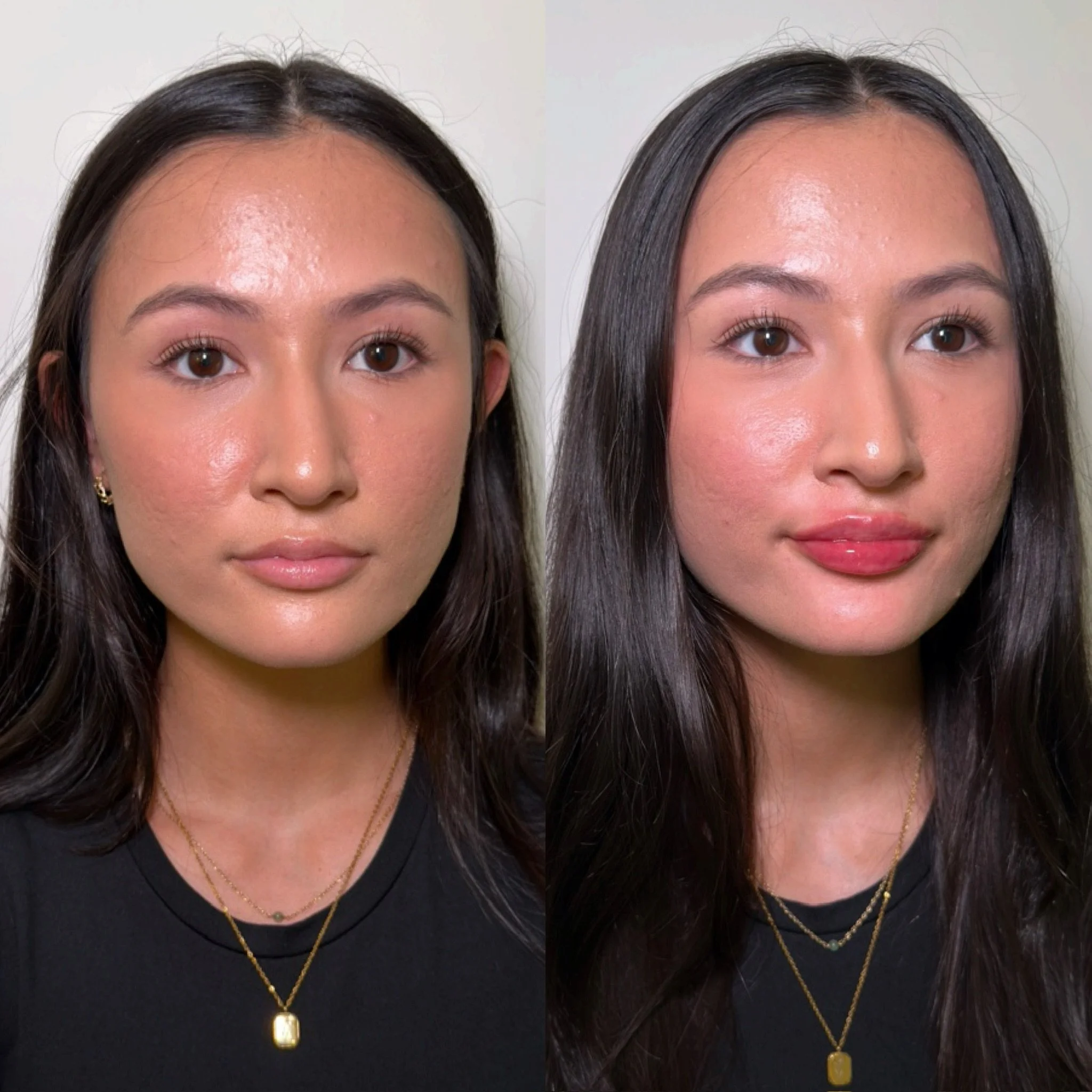 Introducing volume and pout to her lips using the Classic approach.

My beautiful client wanted to add subtle but noticeable volume to her lips while also introducing lateral support.

Using the Classic lip technique combined with a few vertical fans