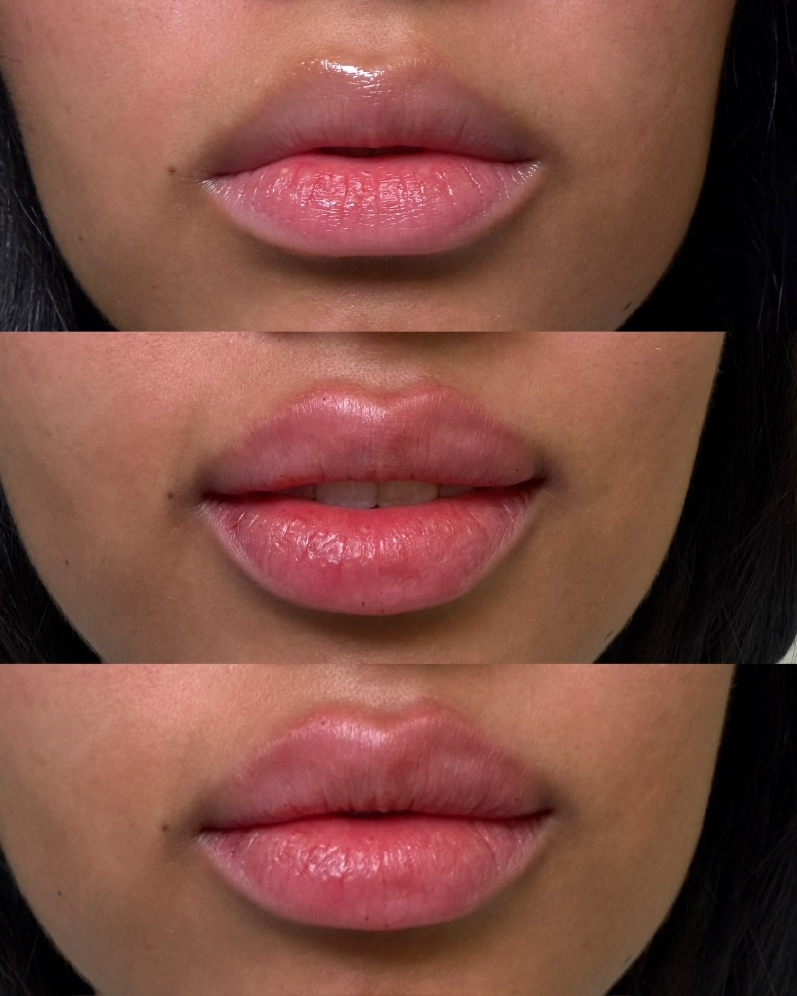 First-time lip filler for definition and height

This patient already had naturally full, beautiful lips and wanted to enhance what was there. The focus was on adding definition and height while maintaining her natural volume and shape. Strategic pla