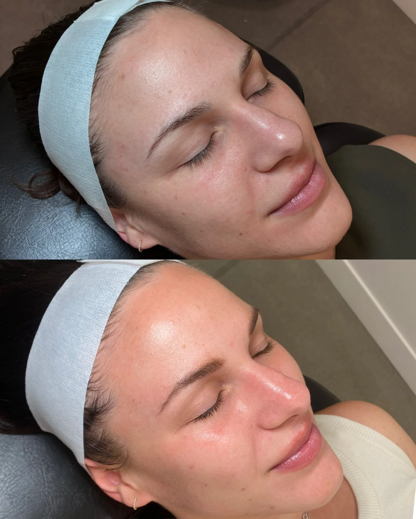 A single Plump Signature Peel! These photos were taken about a month apart. Her skin is so much more even, smooth, and radiant.

We did microneedling today to get her one step closer to her dream skin.

Service: Plump Signature Peel
Provider: Natalie