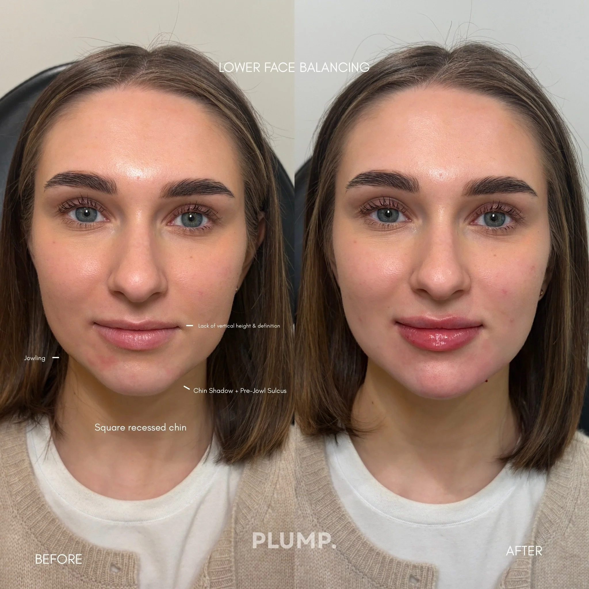 My patients main concern when she presented to our clinic was her lower face. 

She pointed to the &ldquo;indent&rdquo; between her lower cheek, and chin area. This area is called the pre-jowl sulcus and or chin shadow. This is a common complaint amo