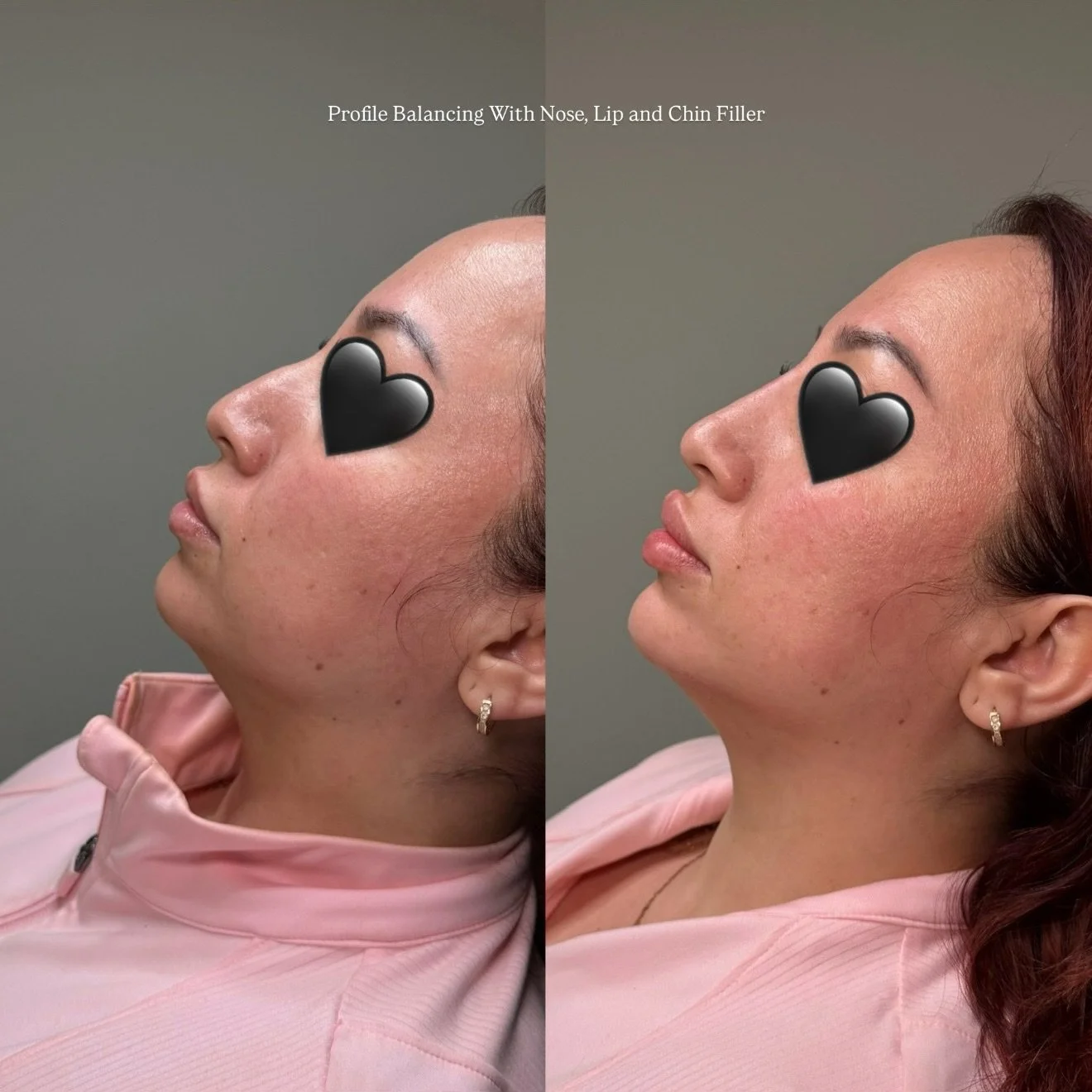 Profile Balancing 

This treatment focused on creating harmony throughout the profile using filler in the nose, chin, and lips. By refining the nasal profile, enhancing chin projection, and balancing lip shape and volume, we were able to create a smo