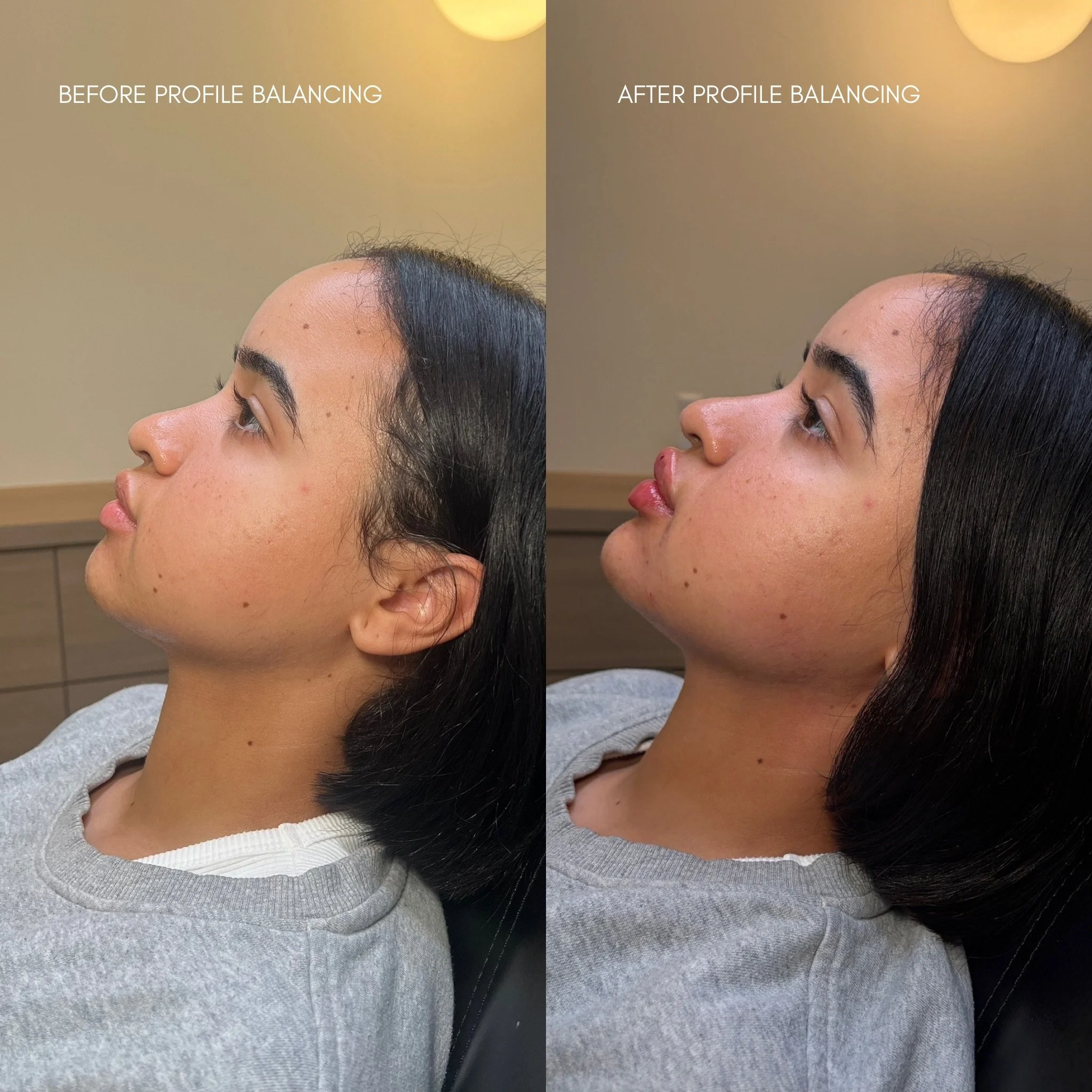 Chin Filler + Lip Filler enhancement to elongate the face 
 
Our gorgeous patient&rsquo;s concern was to reduce the fullness of her upper face. 

Chin augmentations utilizing HA filler can provide elongation and projection of the lower face. In turn,