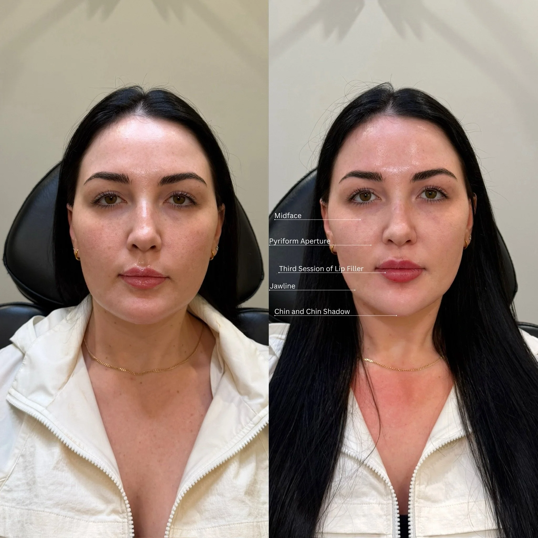 Full facial balancing using filler to restore structure, support, and harmony while keeping everything soft and feminine. 

This patient came in wanting subtle refinement with an overall lifted, more cohesive look. We focused on strengthening facial 