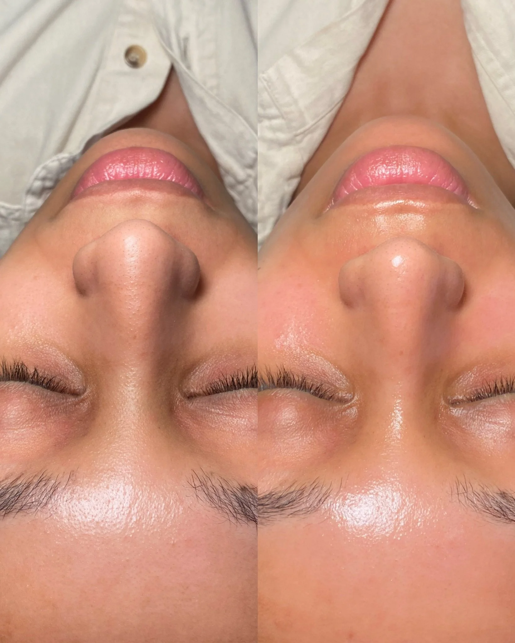 This beautiful client received a Platinum HydraFacial including dermaplaning, lymphatic drainage, exfoliation, mild chemical exfoliation, gentle suction extractions, a customized booster, medical grade red light therapy, and hydration infusion. All o