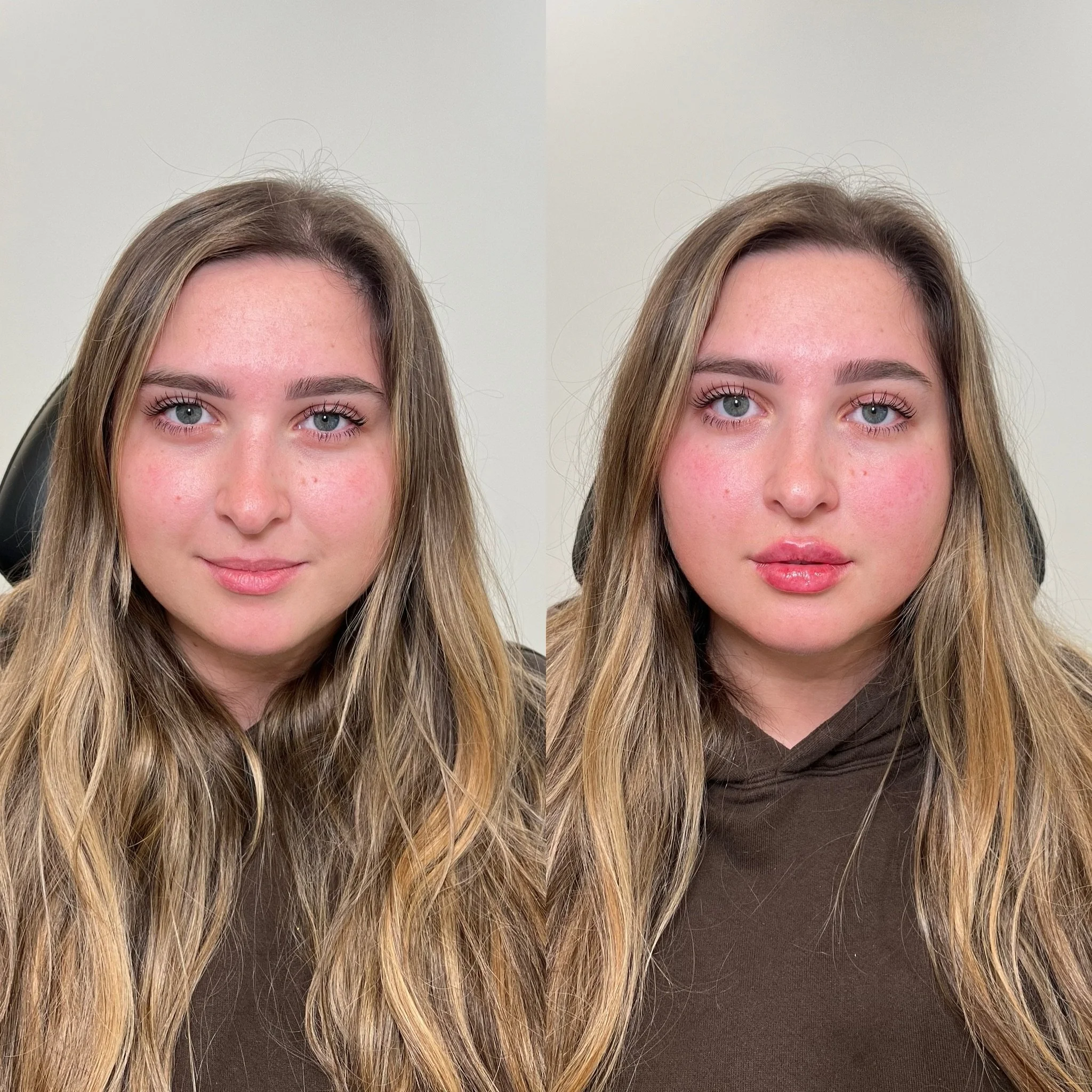 Lip Filler that compliments your features > 

One of the best parts of customized lip filler is ensuring that our patients new lips will match their every day aesthetic. Whether that be more natural, or dramatic, together we discuss their goals an