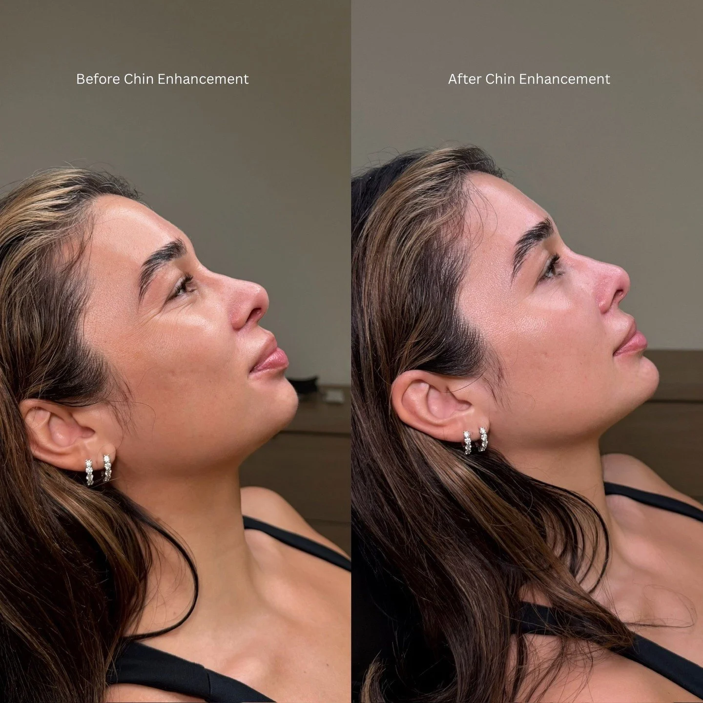 Chin Enhancement

We always consider the surrounding areas when addressing the chin so the results feel cohesive and natural. This may include treating the pre-jowl sulcus, chin shadowing, the chin itself, and in some cases, the jawline. Typically, 2