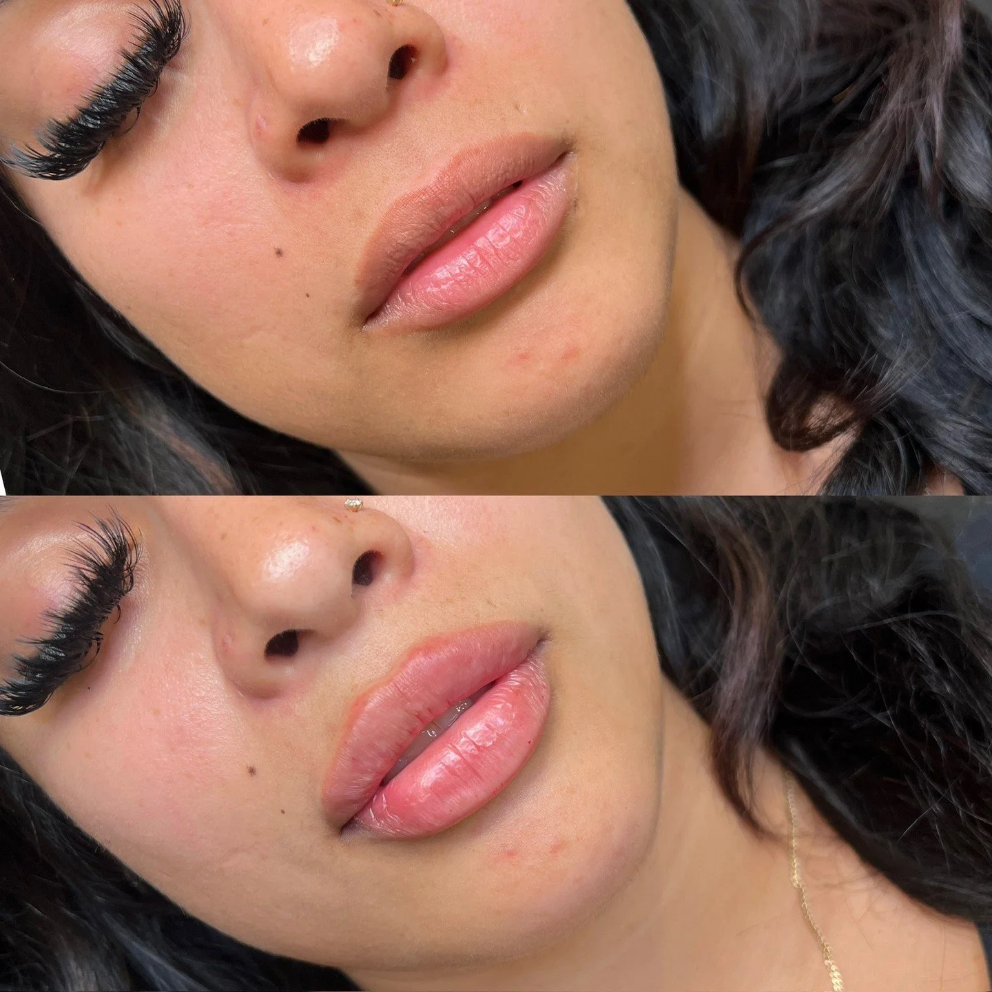 First time lip filler appointment 

This patient wanted to maintain her natural anatomy, yet increase the vertical height as well as define her shape. A concern for her was during smiling, she felt as though her lips &ldquo;disappear&rdquo;. While fi