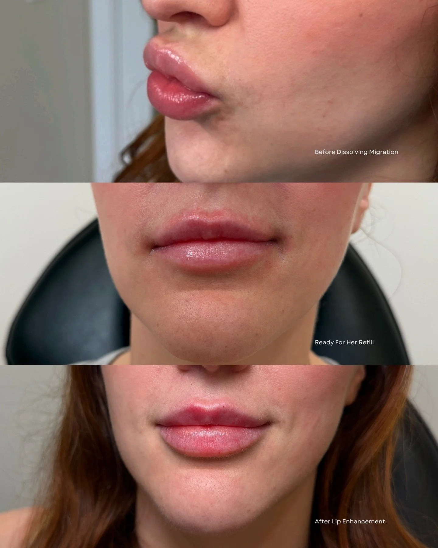 Lip Journey 

After dissolving previous migration from past treatments, we waited a full year of healing before rebuilding her shape. This session focused on central height, soft structure, and a more defined Cupid&rsquo;s bow while keeping everythin