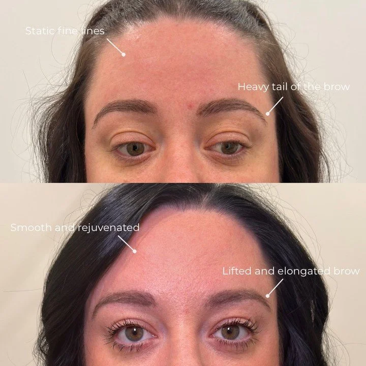 Performing upper face tox can be tricky - no two people's anatomy will ever be exactly the same. Using one treatment pattern for all clients simply doesn't cut it.

Getting a seamless, refreshed result requires a deep understanding of the underlying 