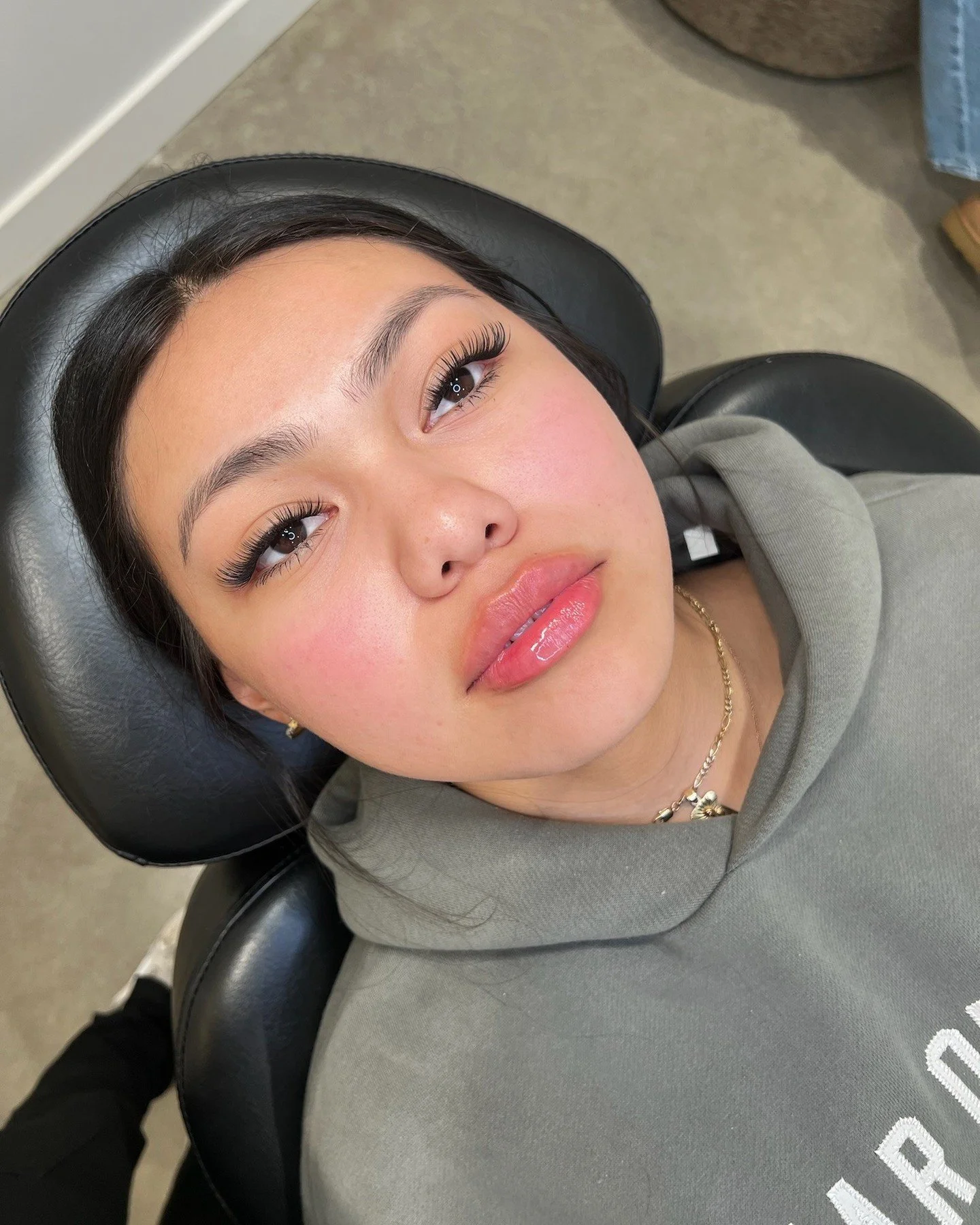 Lip Filler for symmetry correction 

A common request among our filler patients is to address asymmetries of the lips. Most lips naturally have asymmetries, anywhere from minor to major size and shape differences. 

As an injector, it is important to
