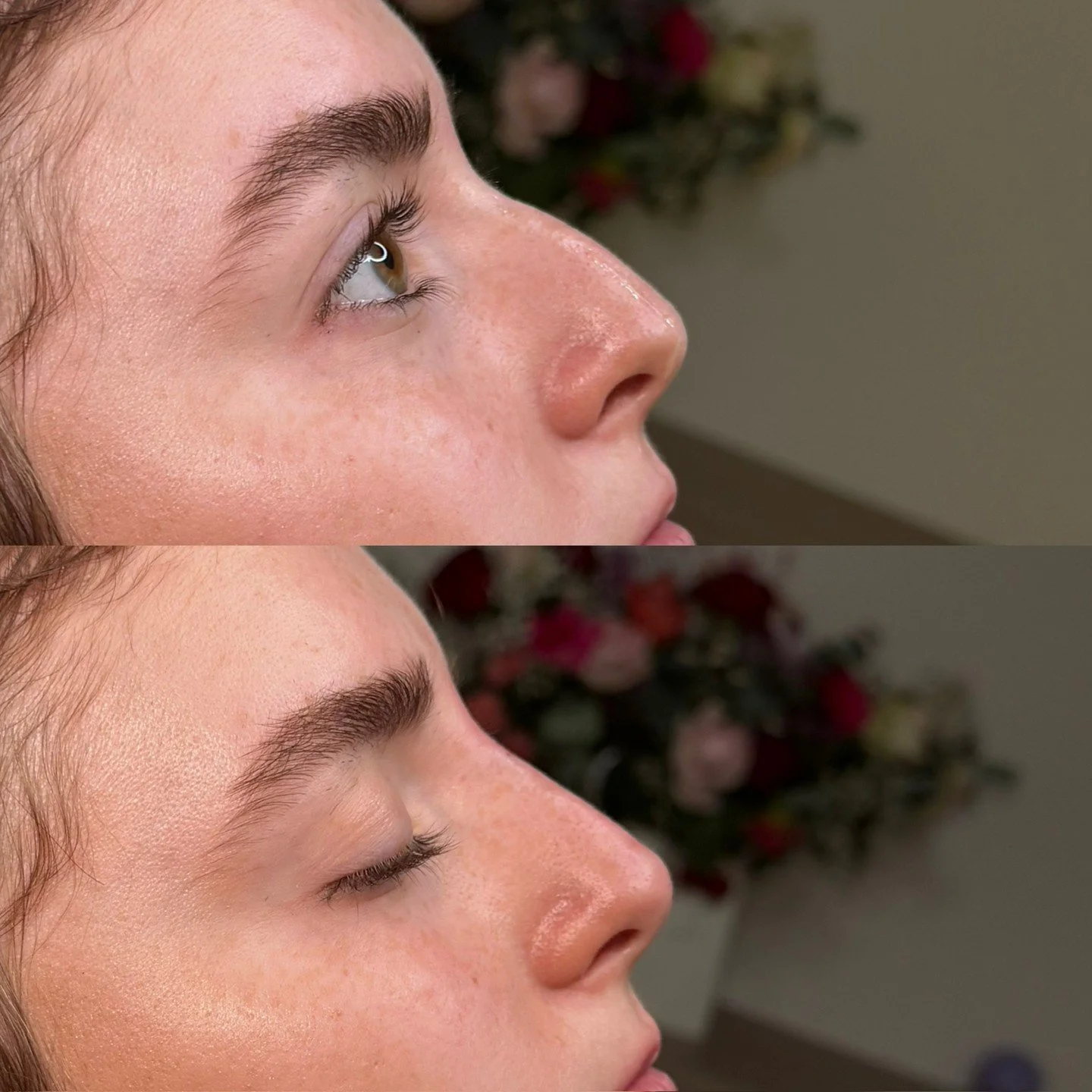 Liquid rhinoplasty for dorsal hump refinement

This treatment focused on blending the dorsal hump while creating a subtle lift through the tip for a smoother, more balanced profile. Strategic placement allowed us to soften irregularities and refine t