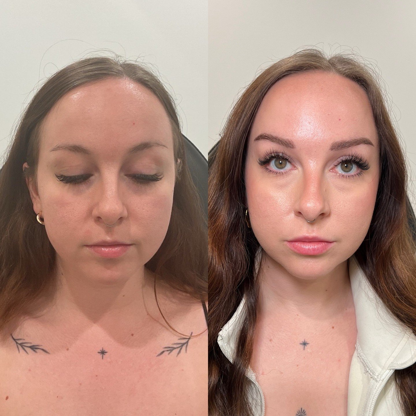 Botox Brow Lift 

Neuromodulator (Botox, or wrinkle relaxer) was used in the upper face to provide the appearance of heighten brows, and an awake appearance. 

Areas treated: 
- 11&rsquo;s (Also known as frown lines) 
- Upper forehead 
- Crows Feet 
