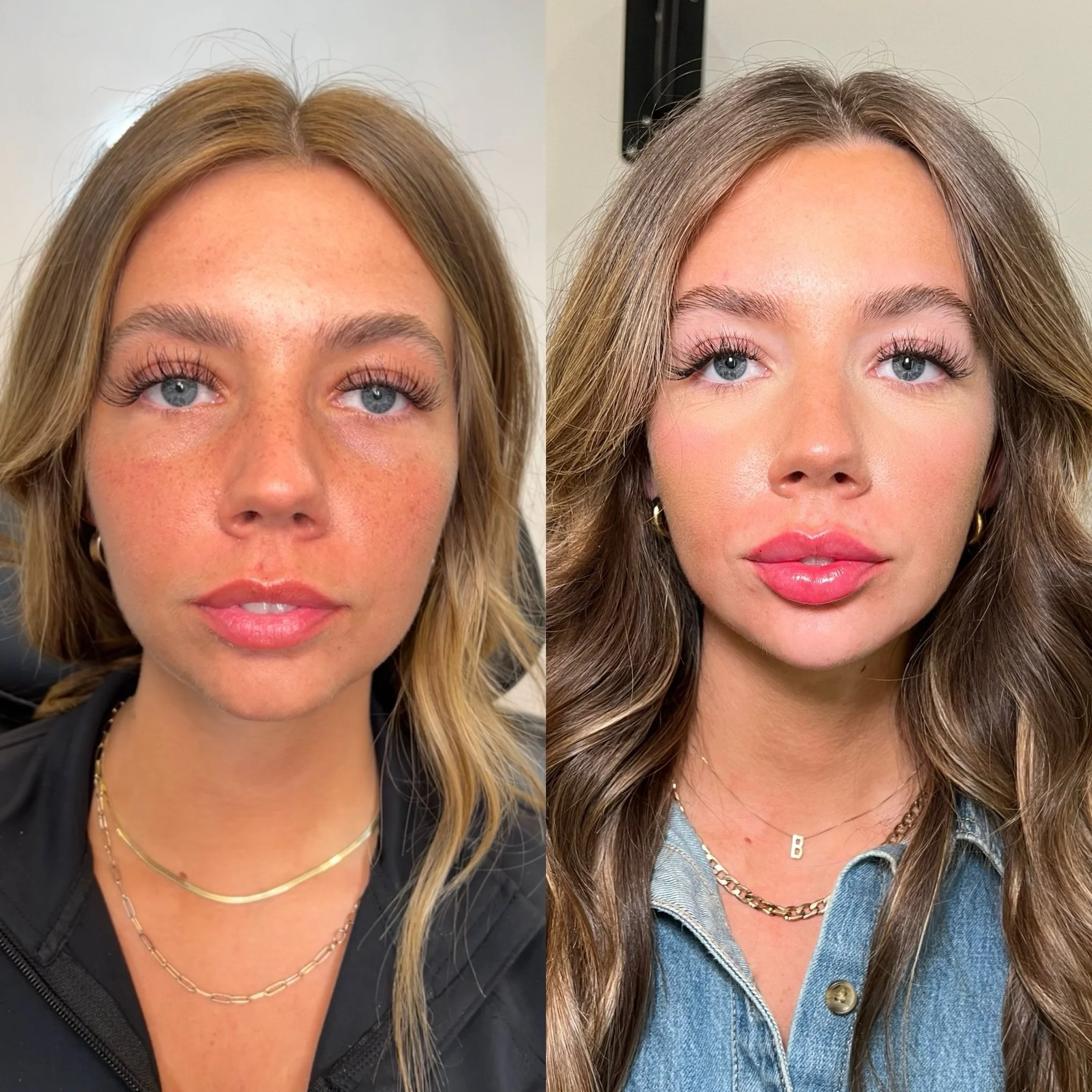 2 years in the making using a combined filler and skin treatment approach. 

To prepare for her wedding, we focused on lower face balancing, lip filler, upper face botox, and skin treatments to make her look as airbrushed as possible for her wedding.