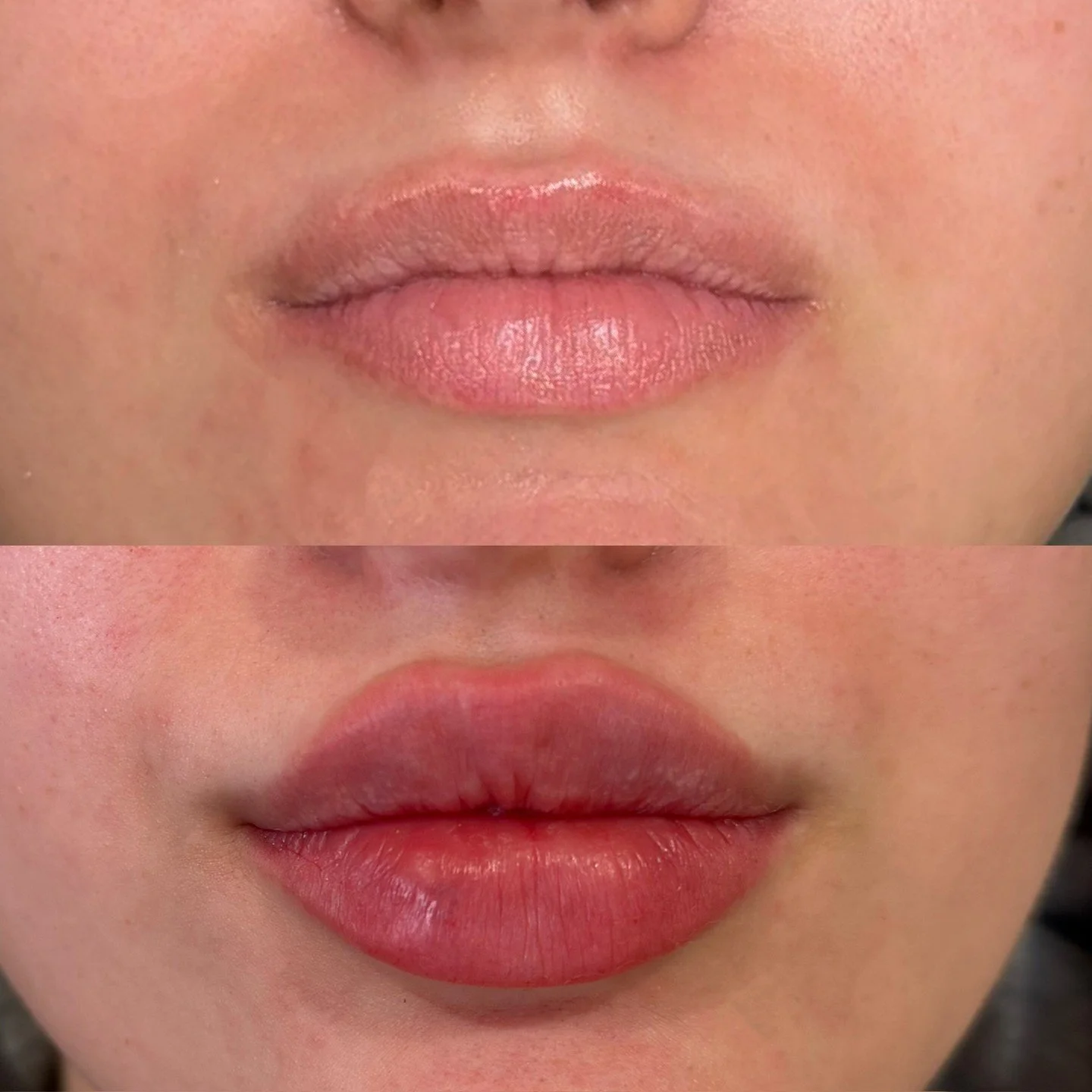 First-time lip enhancement focused on central volume

This treatment focused on creating soft central volume with a defined Cupid&rsquo;s bow and tapered sides for a balanced, natural result. The goal was to enhance shape and structure while maintain