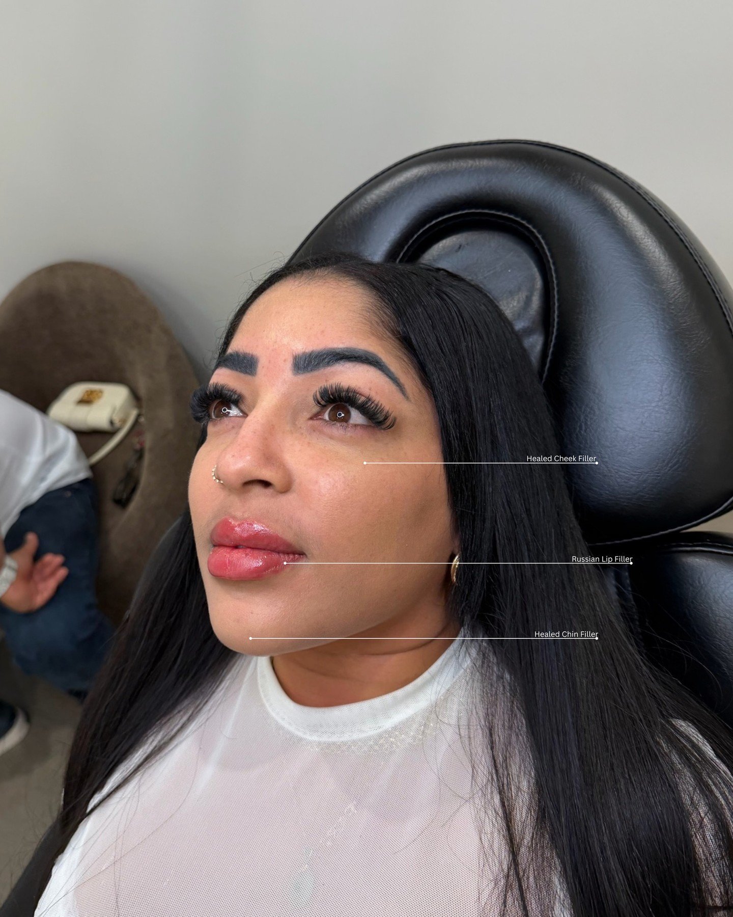 Healed facial balancing + Russian lip enhancement

These updated photos show beautifully healed cheek and chin enhancement from previous treatments completed weeks prior. At this visit, we added Russian lip enhancement to create more height, definiti