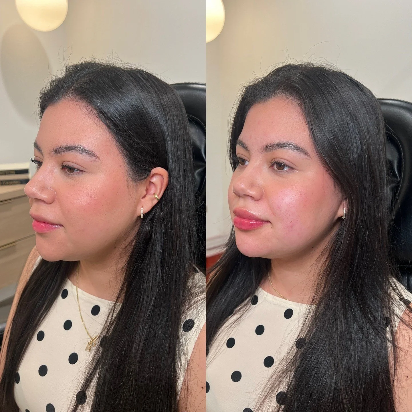 Lower Face Balancing by @plumpedbyemma 

Patient Concerns:
&bull; Lack of jawline definition
&bull; Early jowling
&bull; Lip asymmetry

Our goal was to create a smoother, more seamless transition between the chin and jawline while minimizing the appe