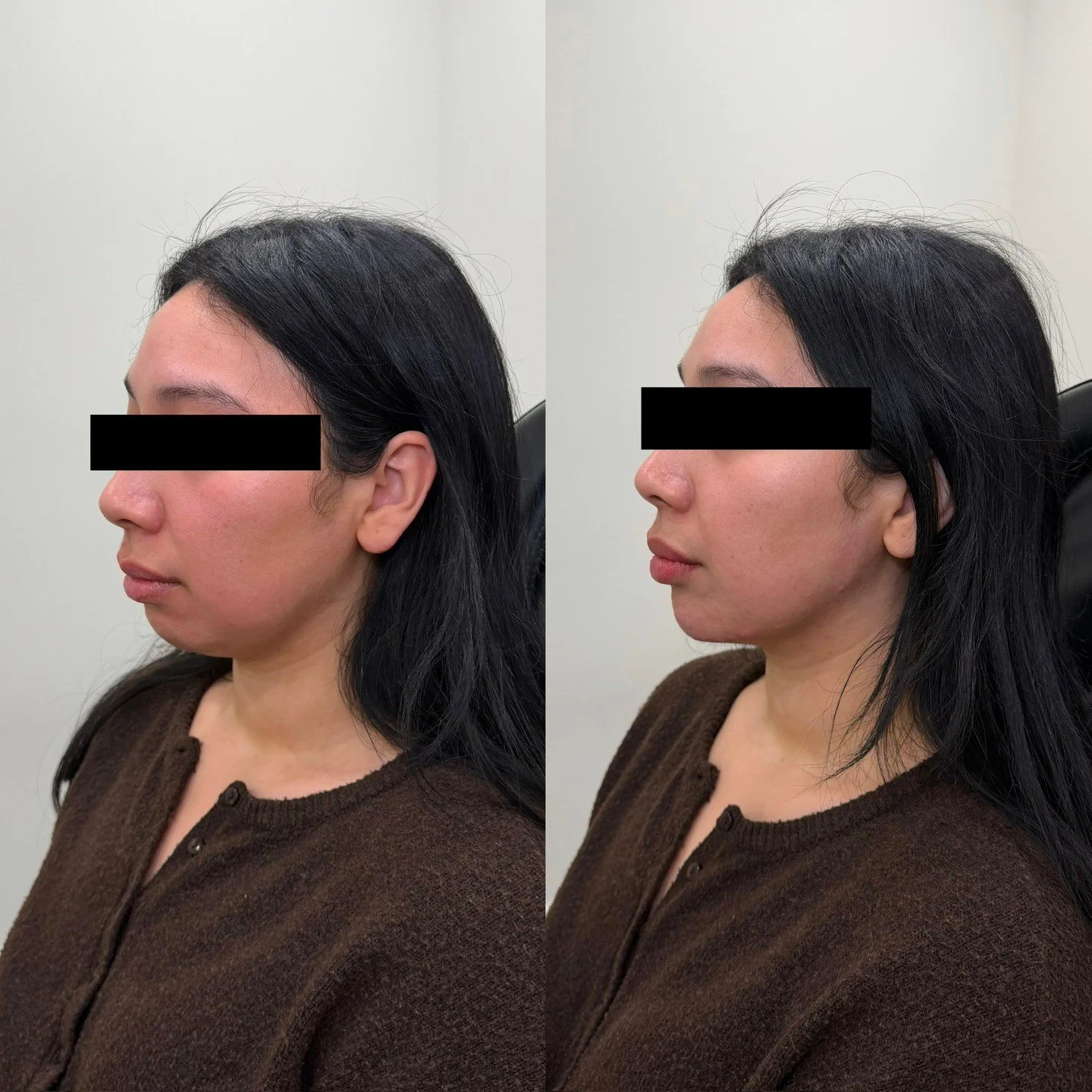 Chin + lip enhancement for profile balancing

This treatment focused on enhancing the chin and lips to create a longer, more balanced profile. We used 3 syringes in the chin to maximize length and projection while maintaining a feminine, cohesive res