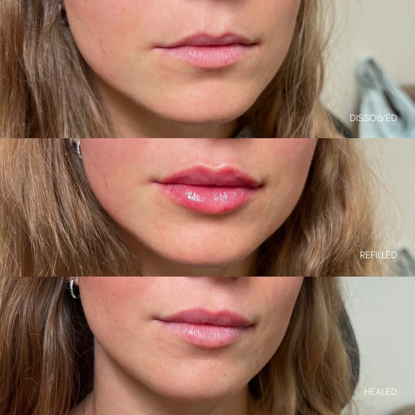- Lip Rehab Journey -

One of our highest priorities at Plump is preserving the health and integrity of your lip tissue.

This beautiful patient came to us with filler migration above the lip border. Although she already had filler present, she still