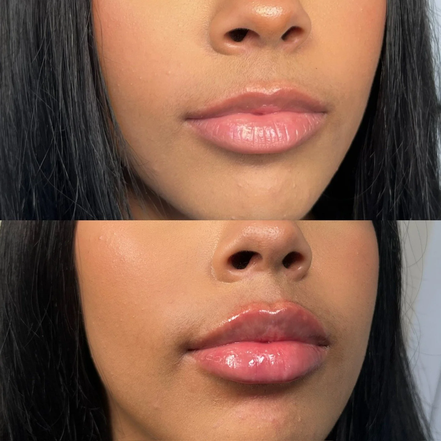 Lips crafted with balance and harmony at the forefront.

By adding gentle volume and vertical height, we were able to give her the result she was seeking while harmonizing the lips along with her other features.

Structured and supported, but still v
